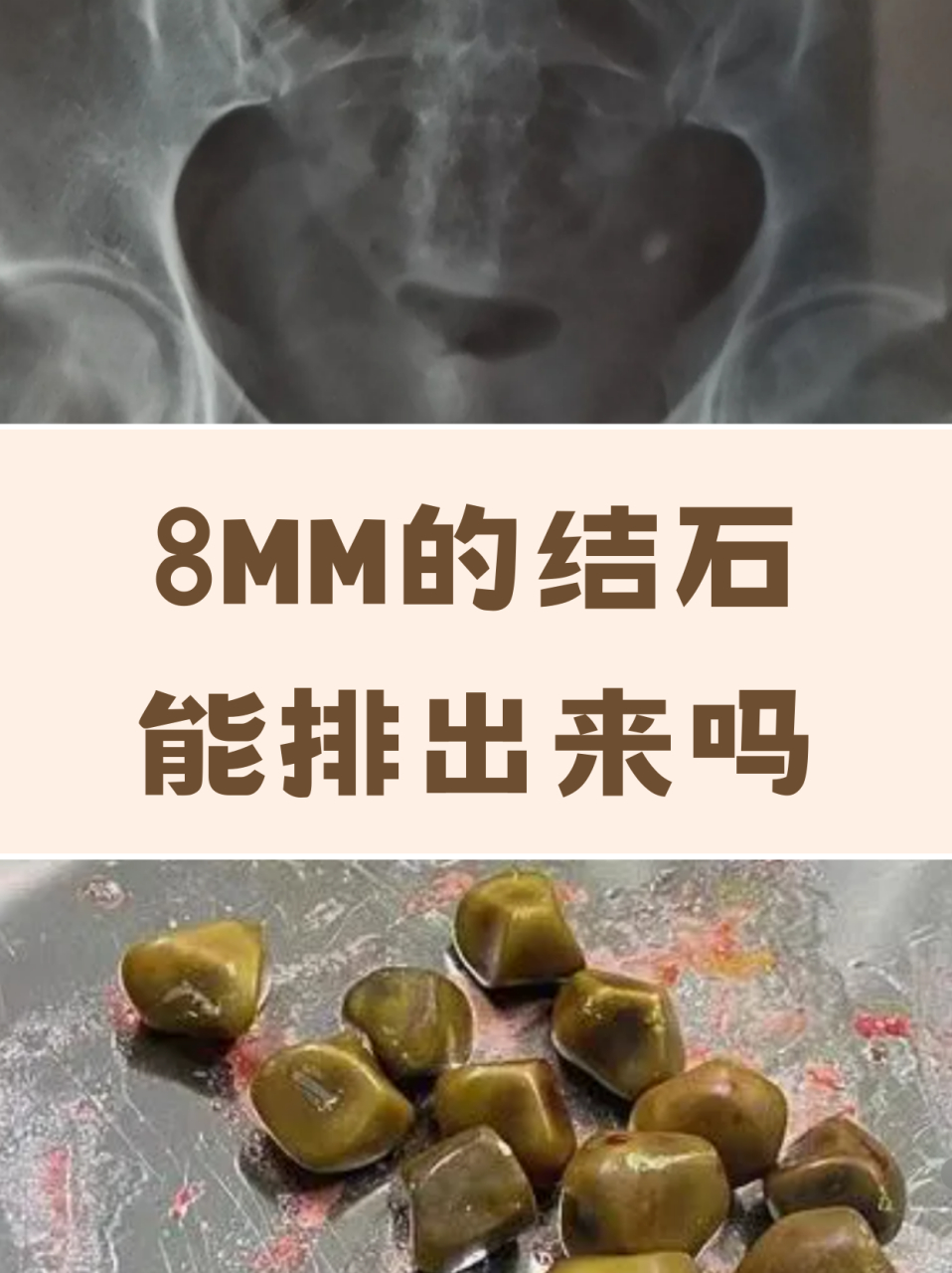 8mm结石能排出来吗 患者男性,今年42岁,去年体检出了肾结石,他没在意.