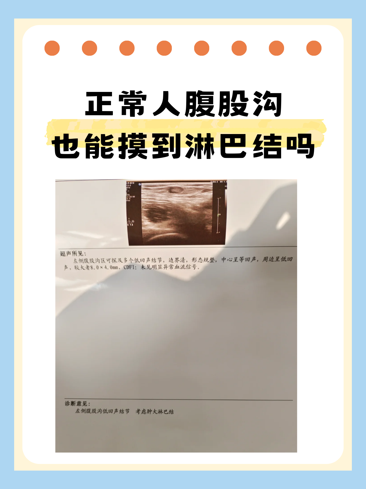 腹股沟有淋巴结一般是正常的