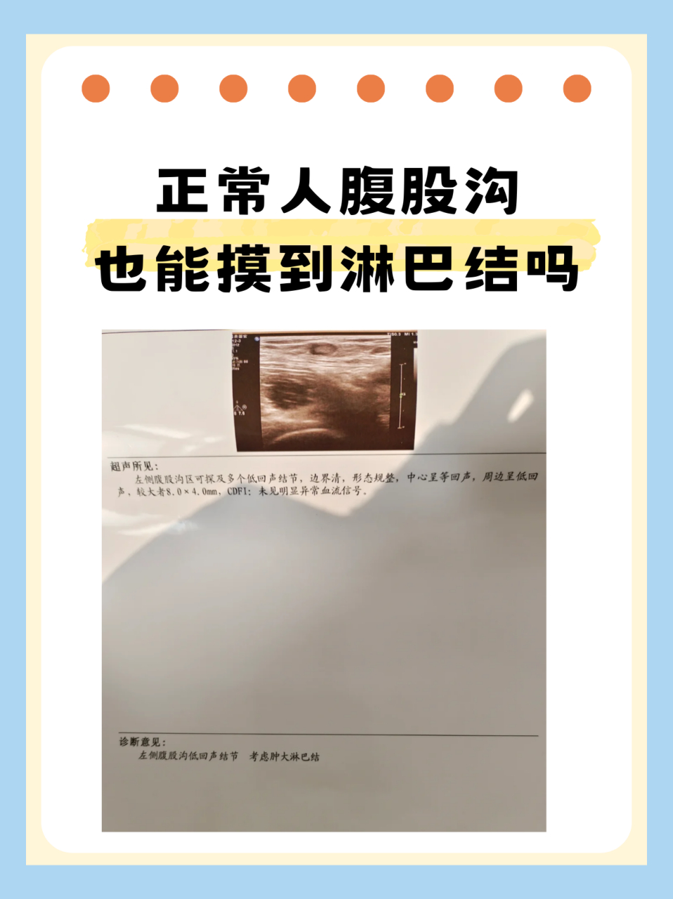 正常人腹股沟也能摸到淋巴结吗  门诊中经常会遇到淋巴结相关的问题