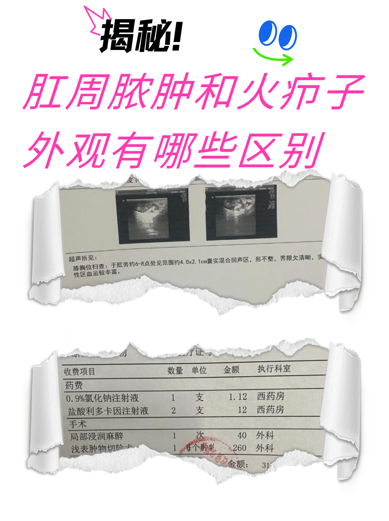 判断肛周脓肿和毛囊炎图片