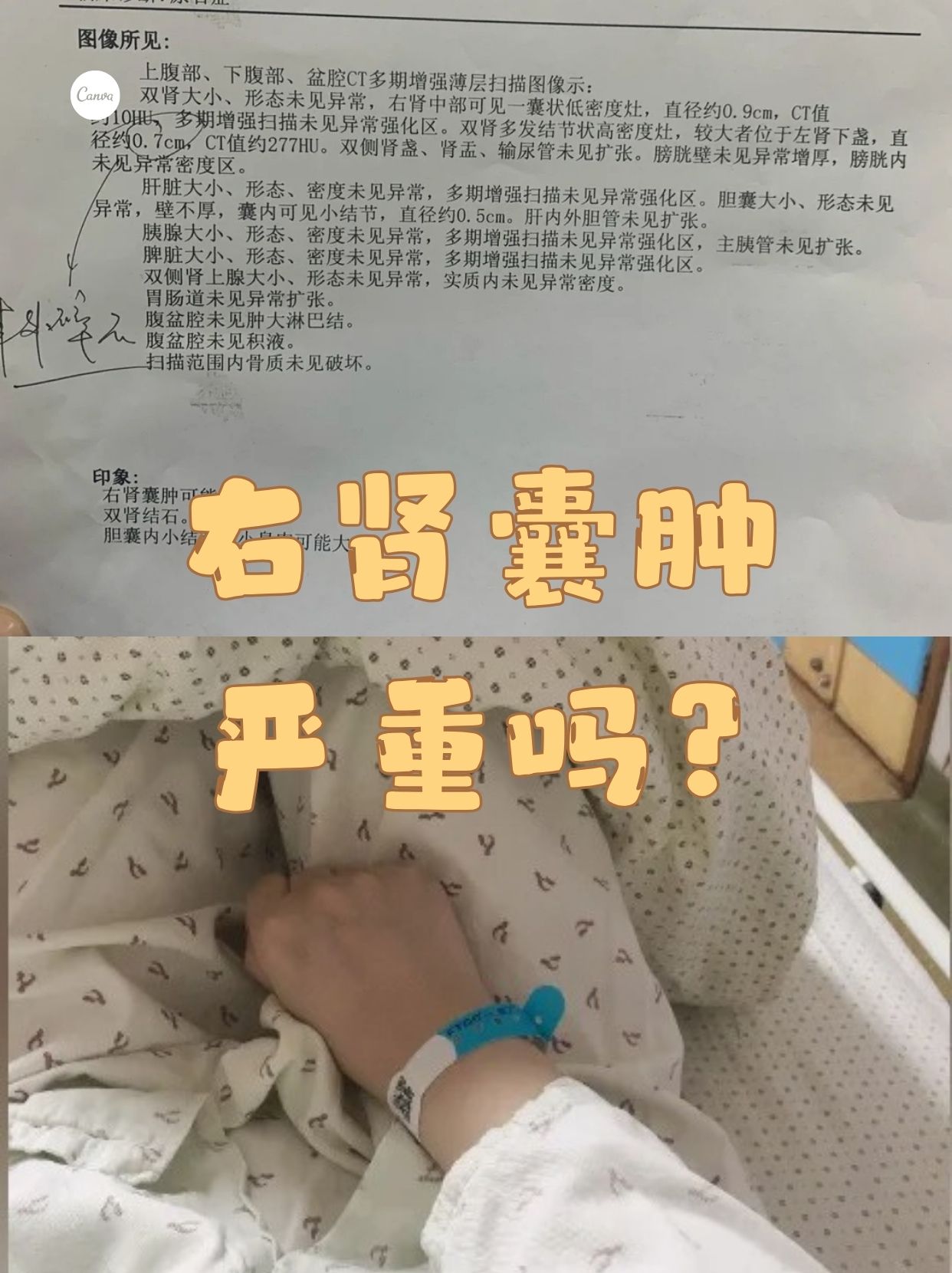 右肾囊肿严重吗 肾囊肿是肾脏常见的一种结构异常,当发现有右肾囊肿时