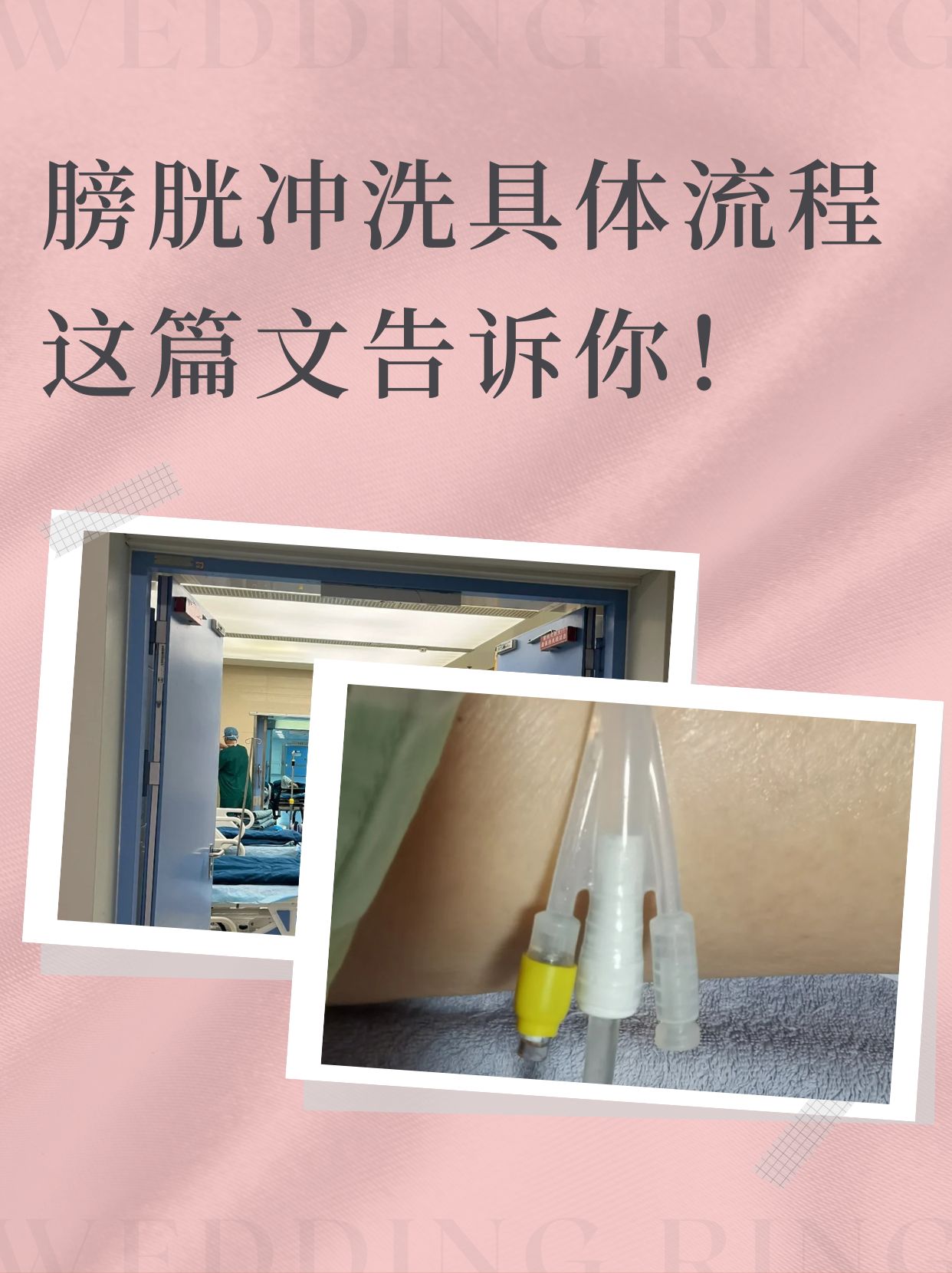 冲洗图示膀胱冲洗图片膀胱冲洗针头扎在什么位置三腔膀胱冲洗示意图