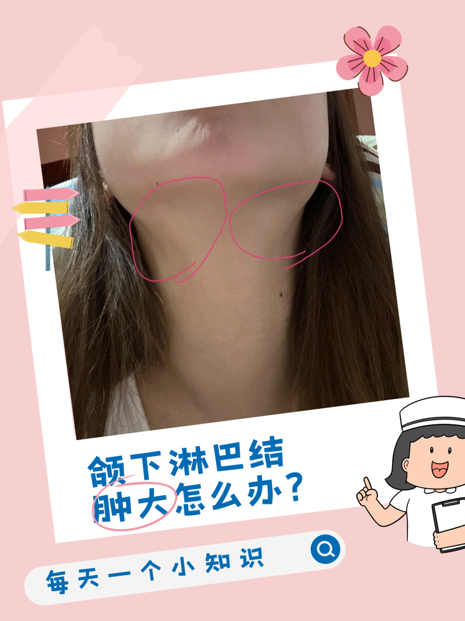 那么颌下淋巴结肿大究竟有哪些治疗方法呢?下面就让我来告诉大家.