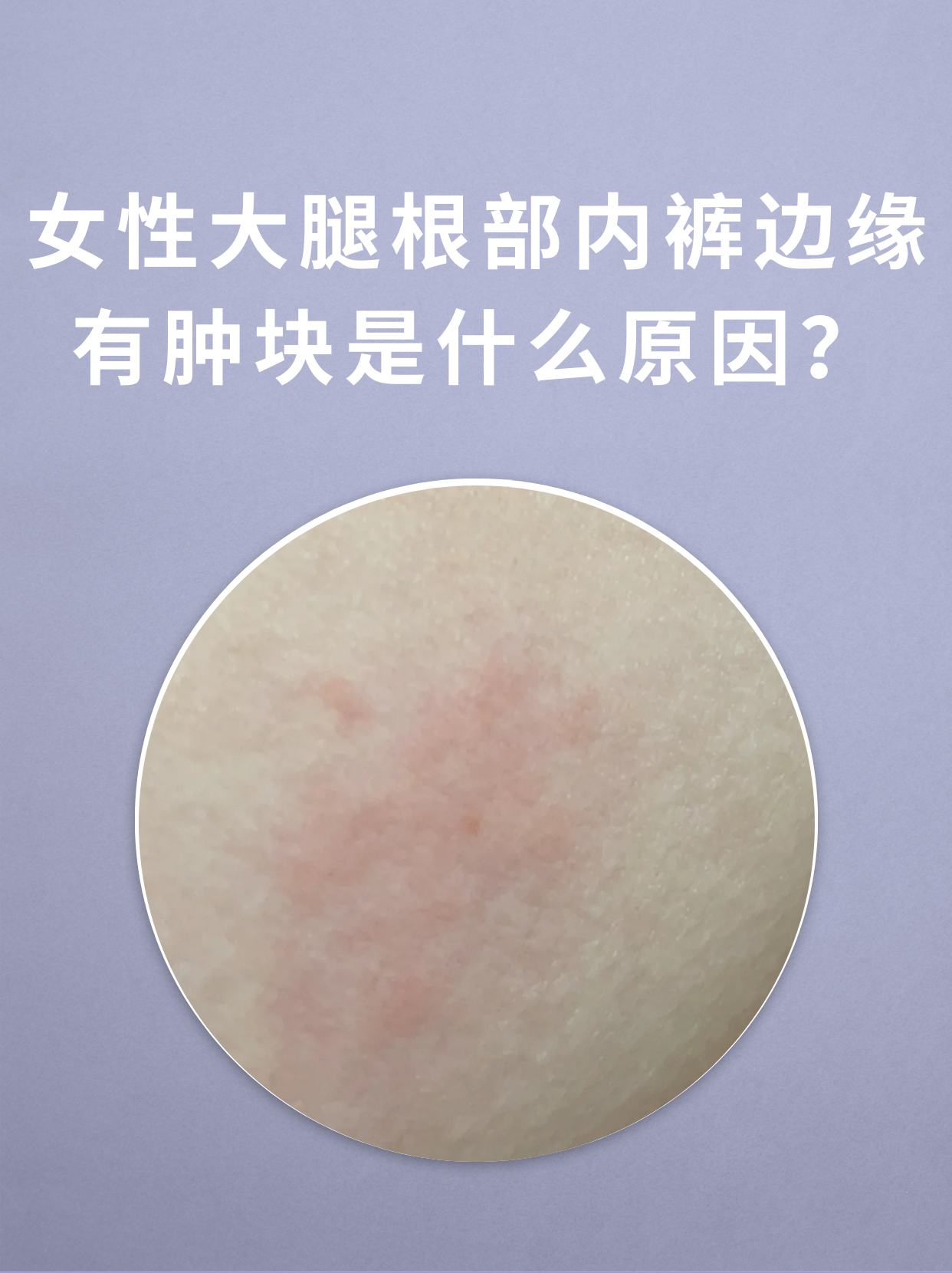 大腿内裤边缘红疙瘩痒图片