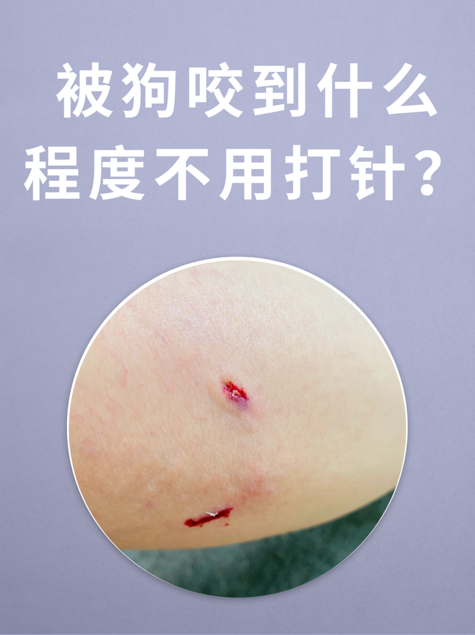 被狗咬到什么程度不用打针 被狗咬到后是否需要打针不能仅仅依据伤口