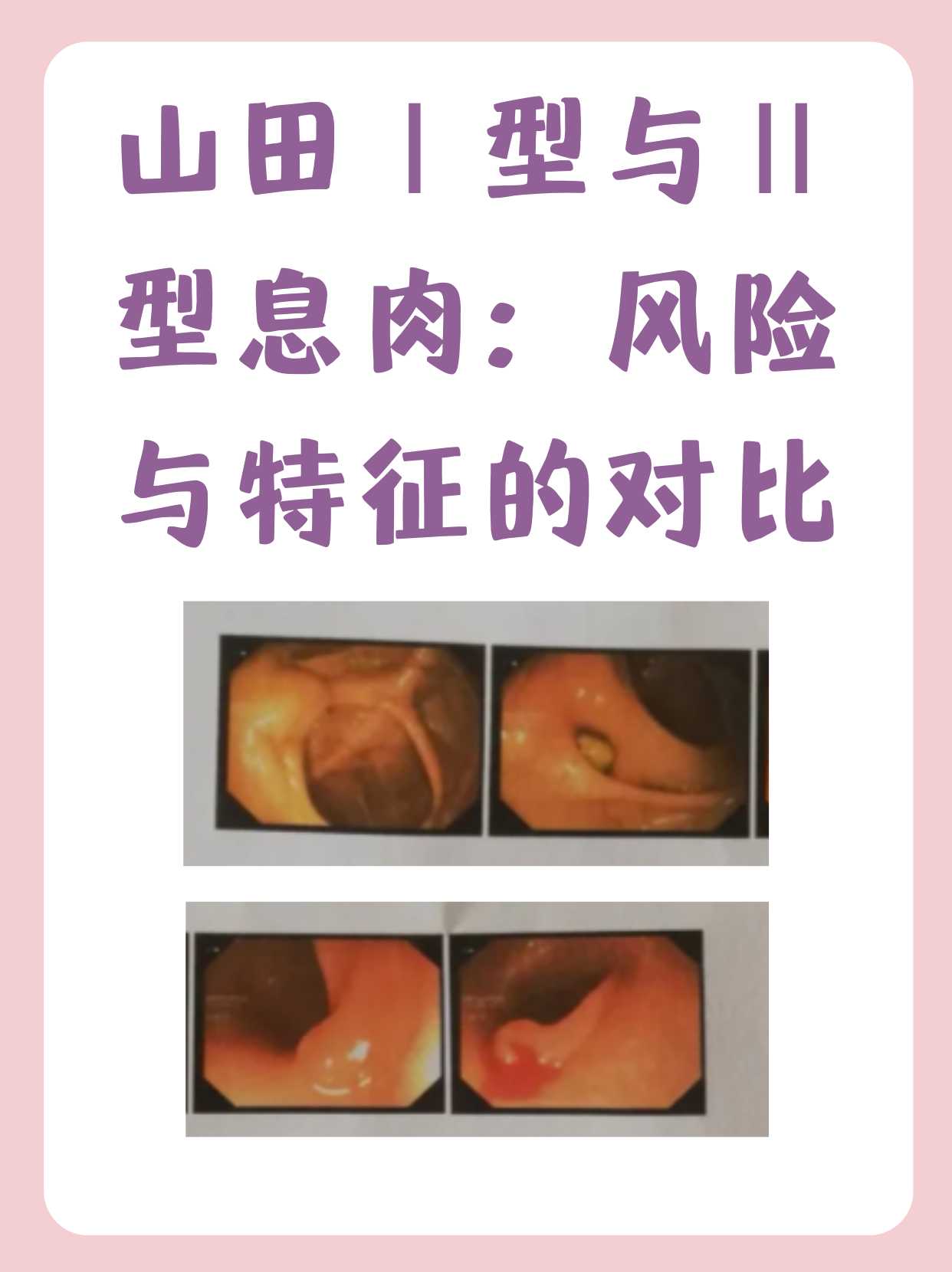 山田Ⅰ型与Ⅱ型息肉的区别 山田Ⅰ型与Ⅱ型息肉在形态特征和潜在风险