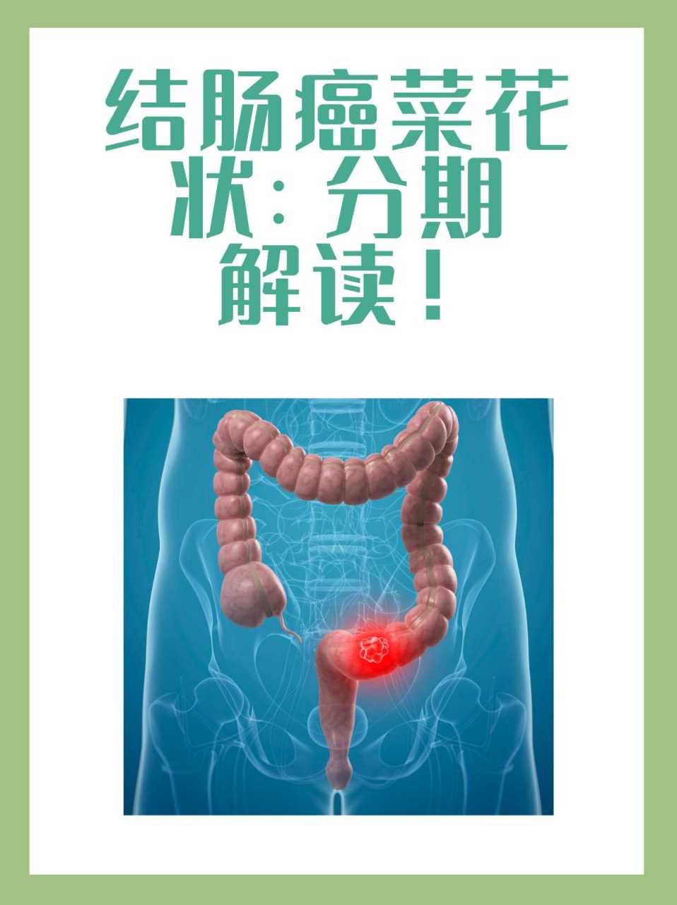 结肠癌菜花状一般是几期 94当在结肠癌的诊断中发现肿瘤呈现菜花状