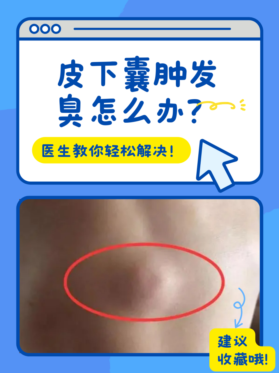 皮下囊肿有臭味是癌变吗 一般来说,皮下囊肿多见的类型是皮脂腺囊肿.