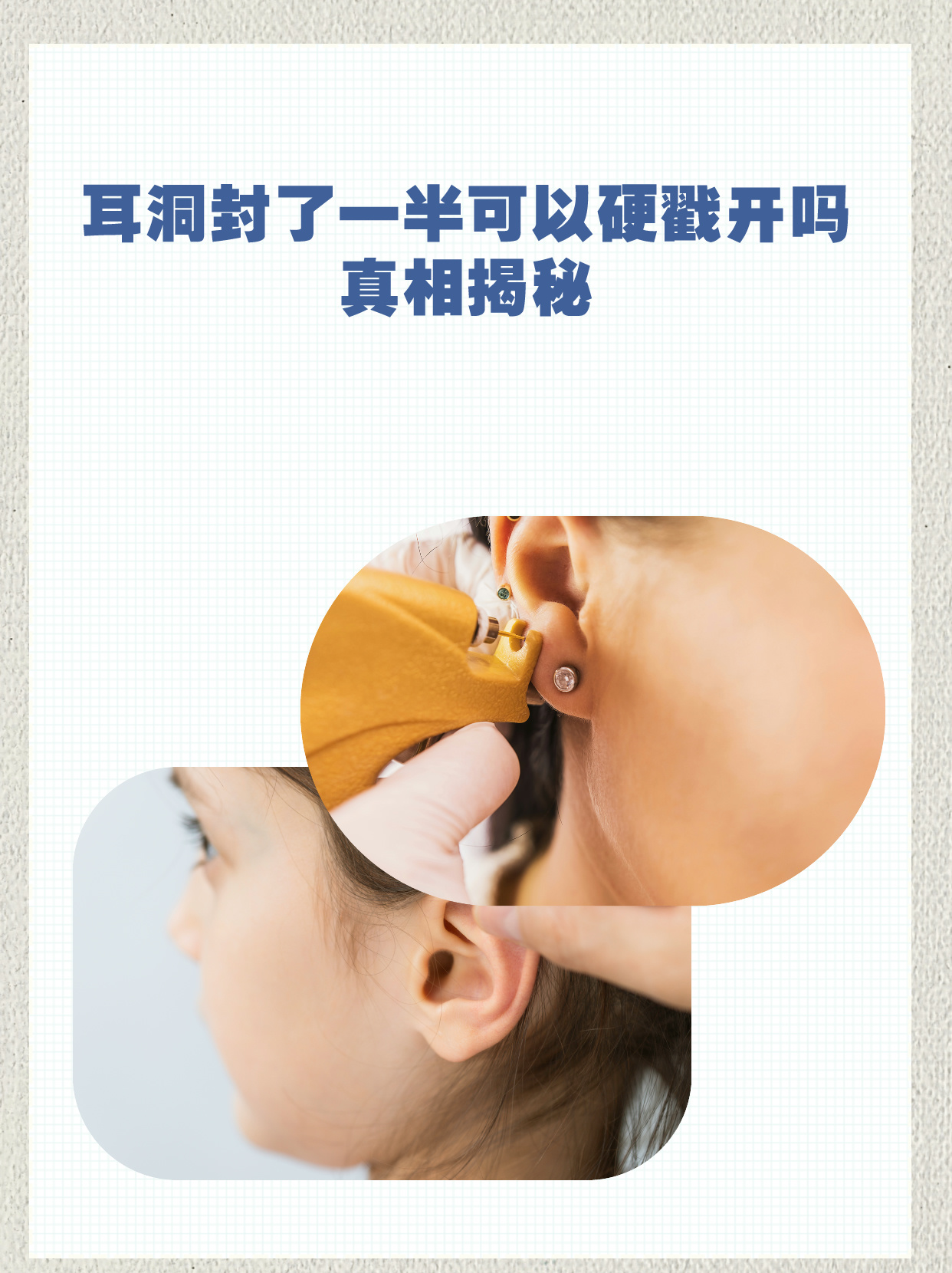 耳洞封了一半可以硬戳开吗 耳洞是通过在耳垂或其他耳部部位穿孔形成