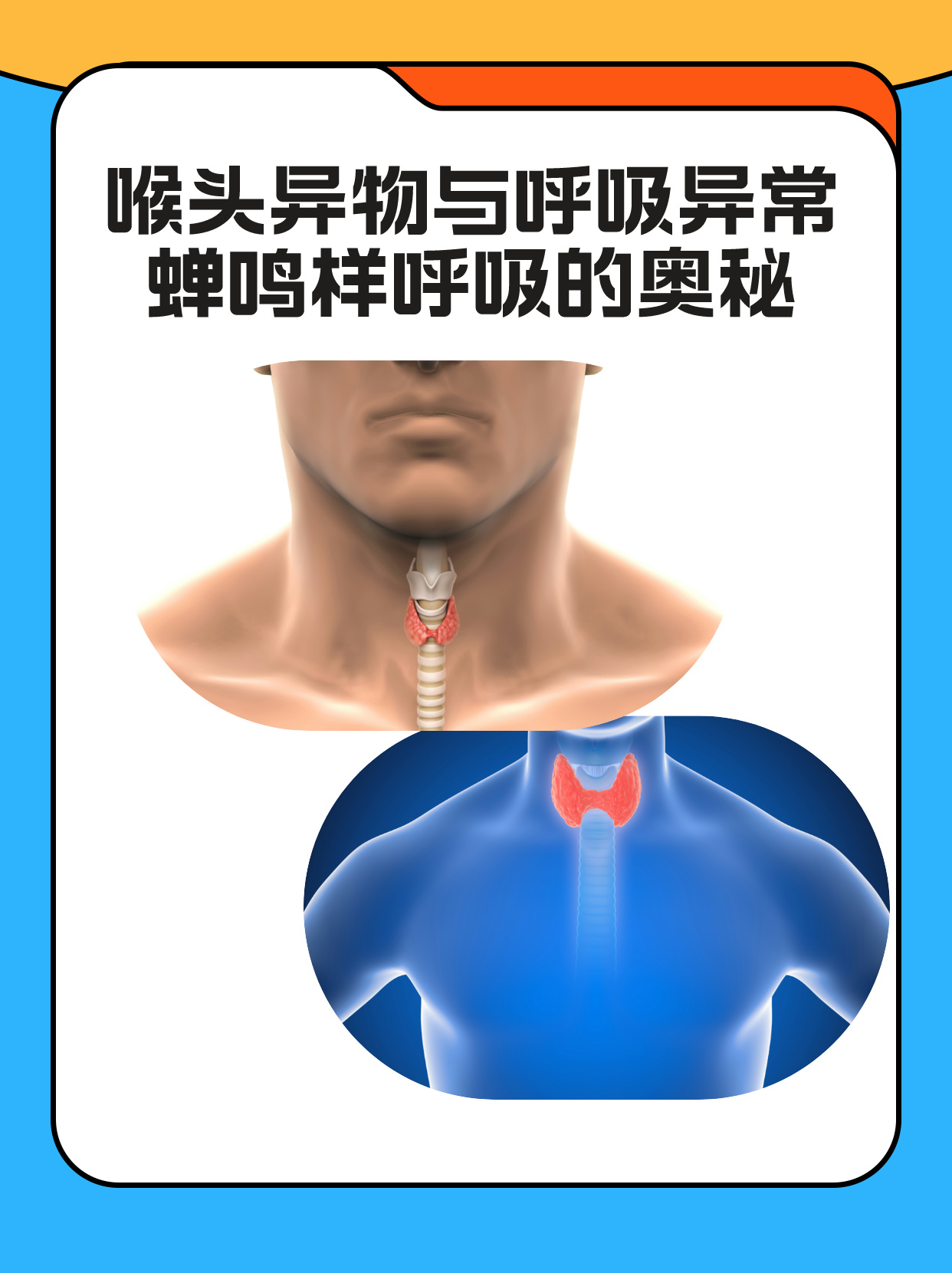 喉头异物呼吸可呈什么呼吸 喉头作为呼吸道的重要关卡,一旦有异物阻塞