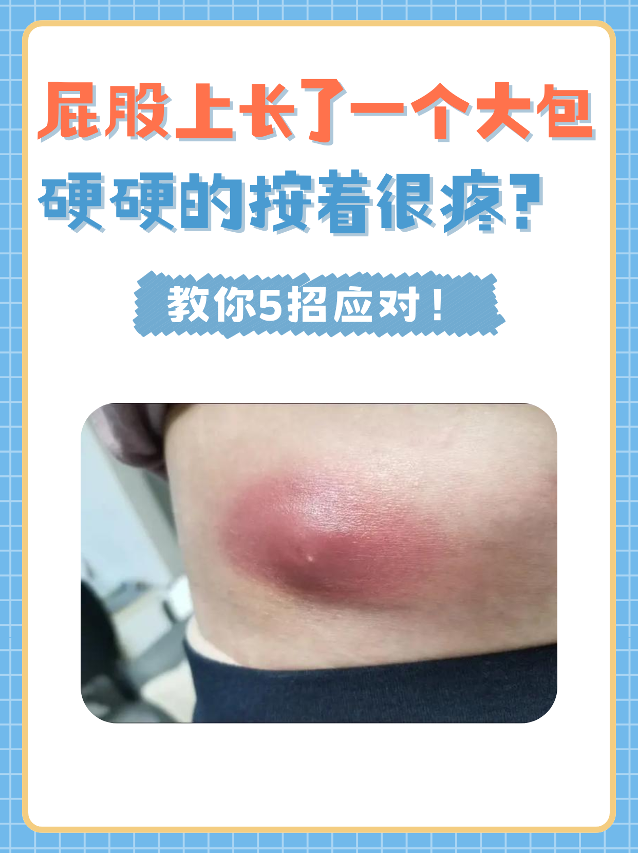 看这篇! 屁股上长了一个大包可能由多种原因引起