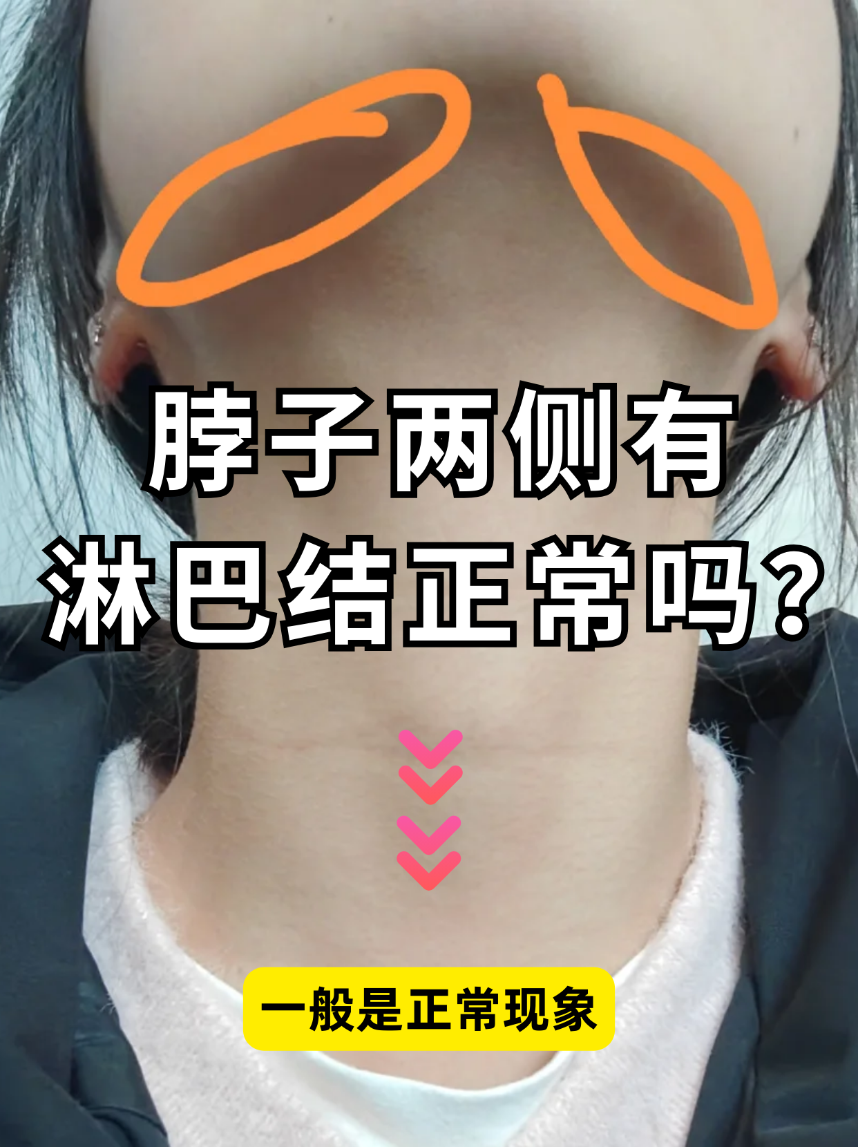 很多人无意中摸到脖子两侧有淋巴结,就会担心是不是身体出了问题