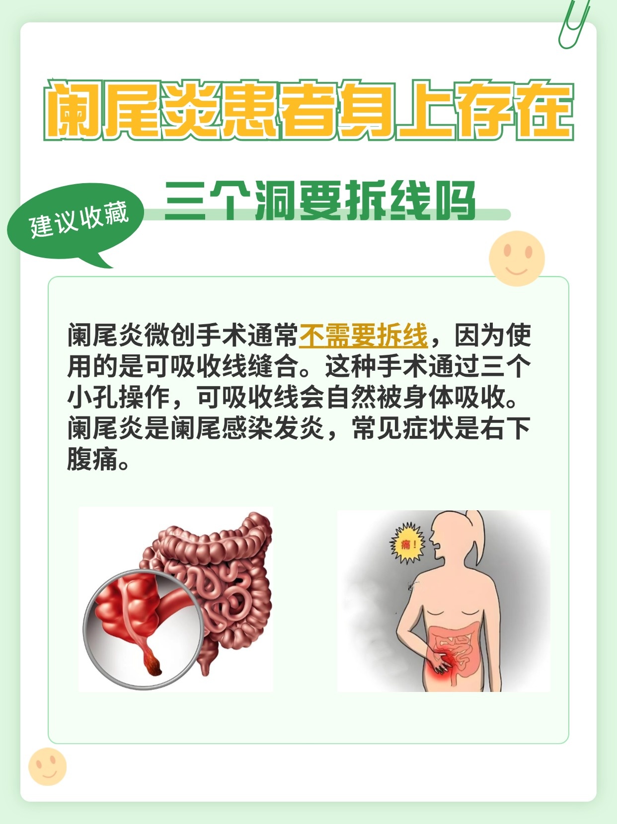 阑尾炎患者在进行腹腔镜阑尾切除术过后身上可能出现三个洞