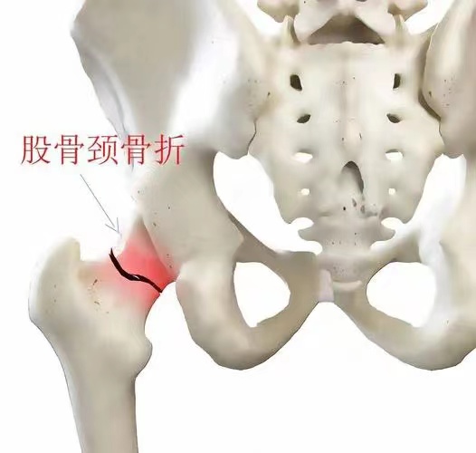 热点引擎计划# 不同部位的骨折,愈合时间也不同!