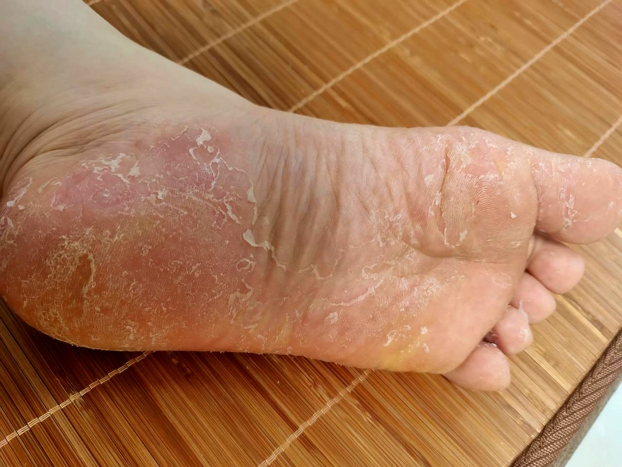 记得我小时候,不知道被谁染上了脚气,这脚气就一直跟着我长大