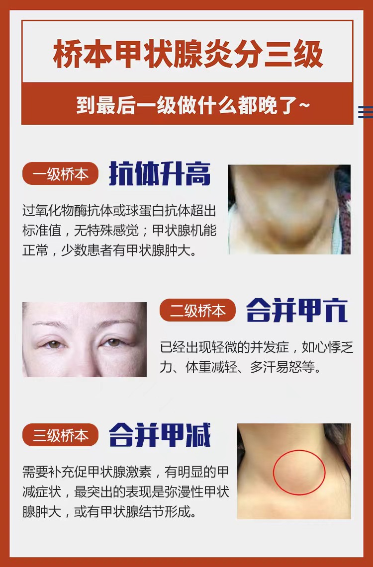 希望大家都重视起来,不要再观望,拖延病症了#桥本甲状腺