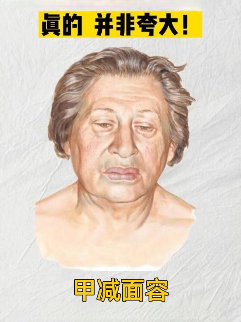 使得面部皮肤甲减面容甲减面容特征图片甲减容貌女性甲减面容特征图片