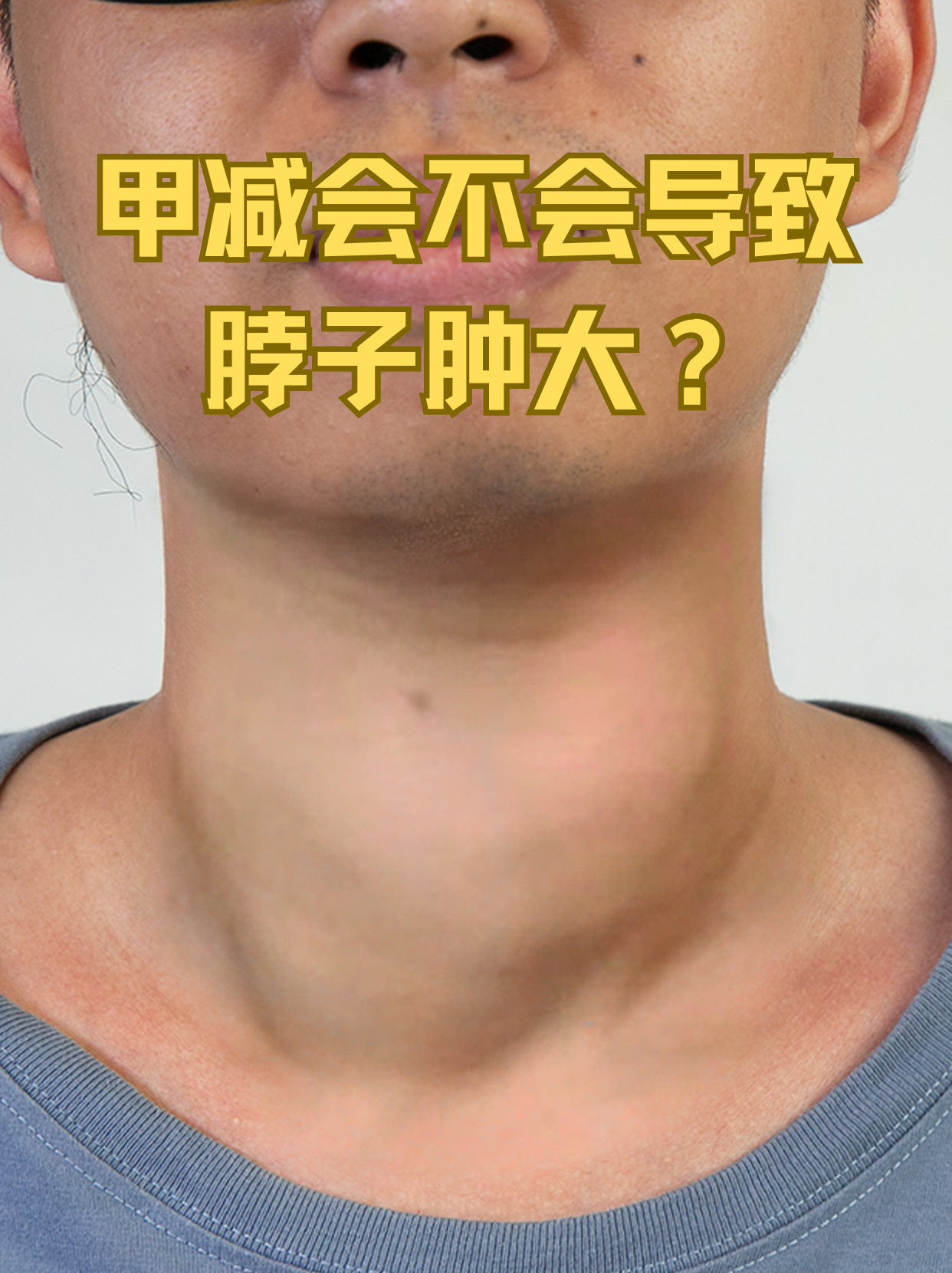 提起脖子肿大,很多人第一时间想到的就是甲状腺功能亢进症