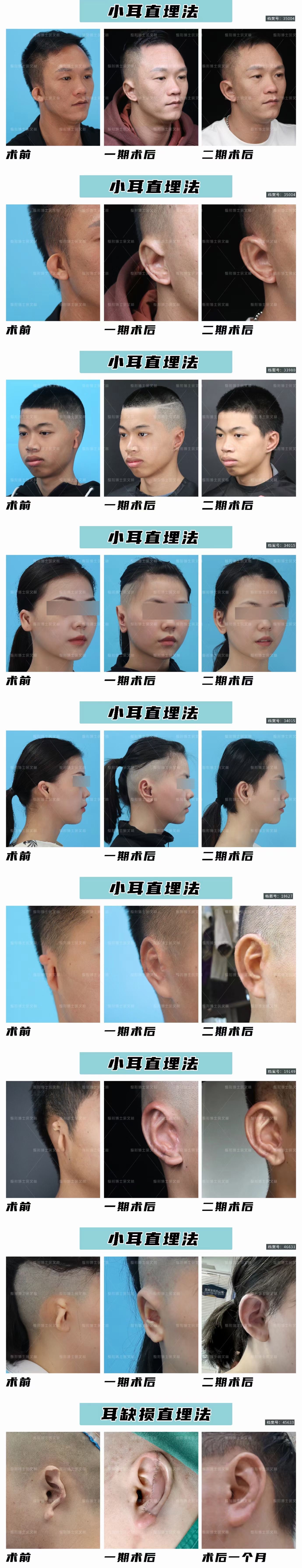 小耳畸形耳再造直埋法的优缺点:  优点  ① 方法简单,不需要扩张皮肤