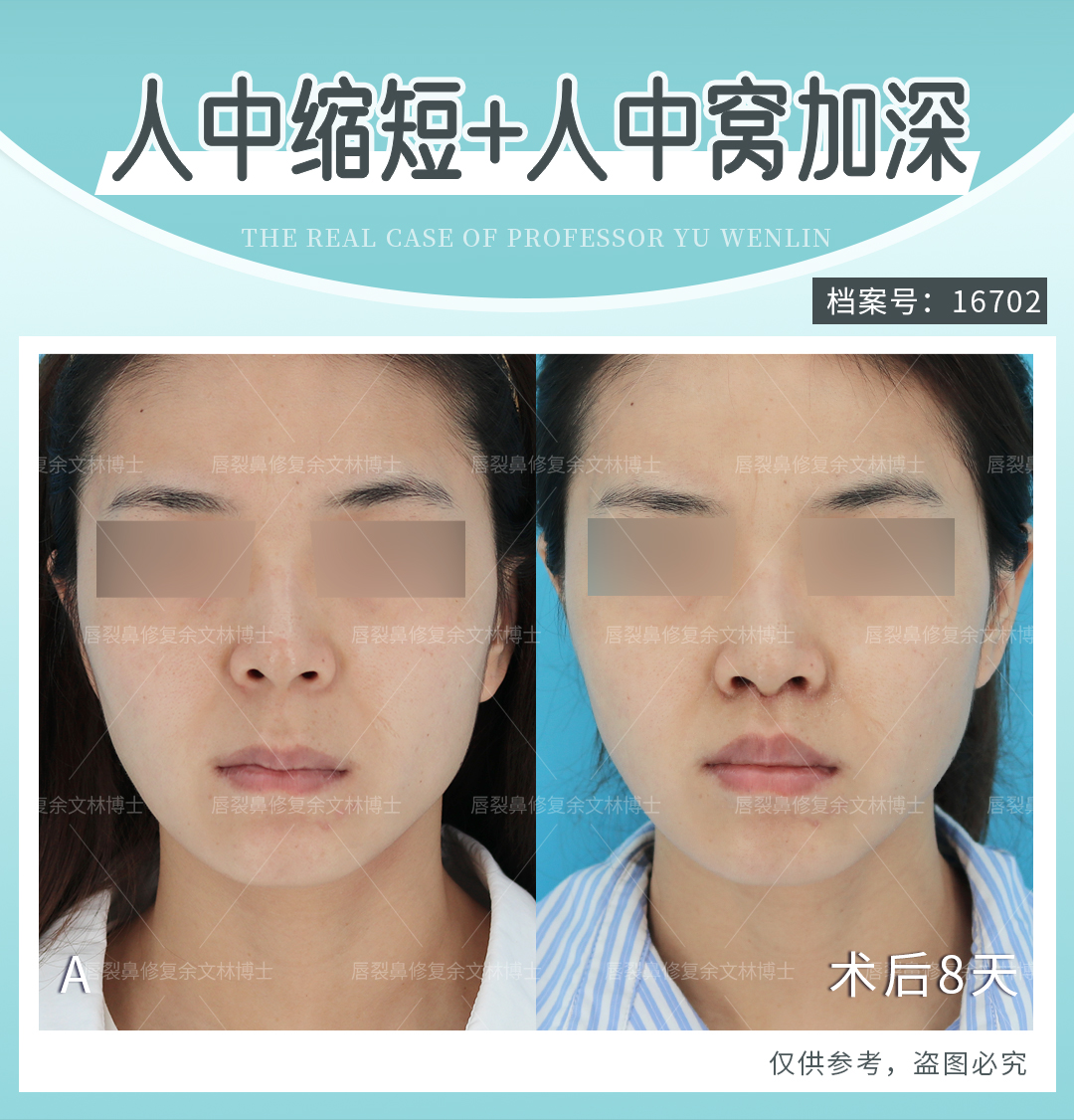 唇裂术后人中形态不佳可以修复吗?