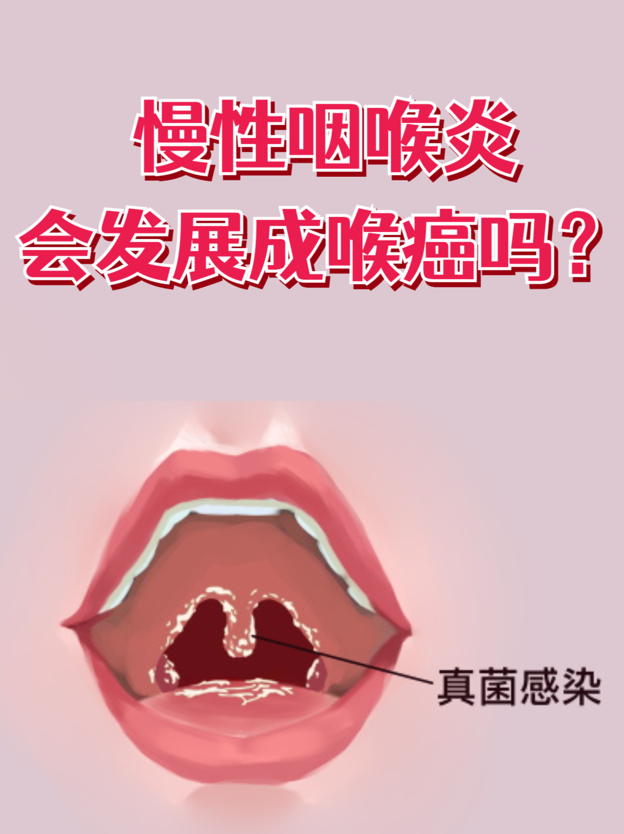  最近嗓子发炎病毒叫什么病毒呢(最近嗓子发炎病毒叫什么病毒呢图片)