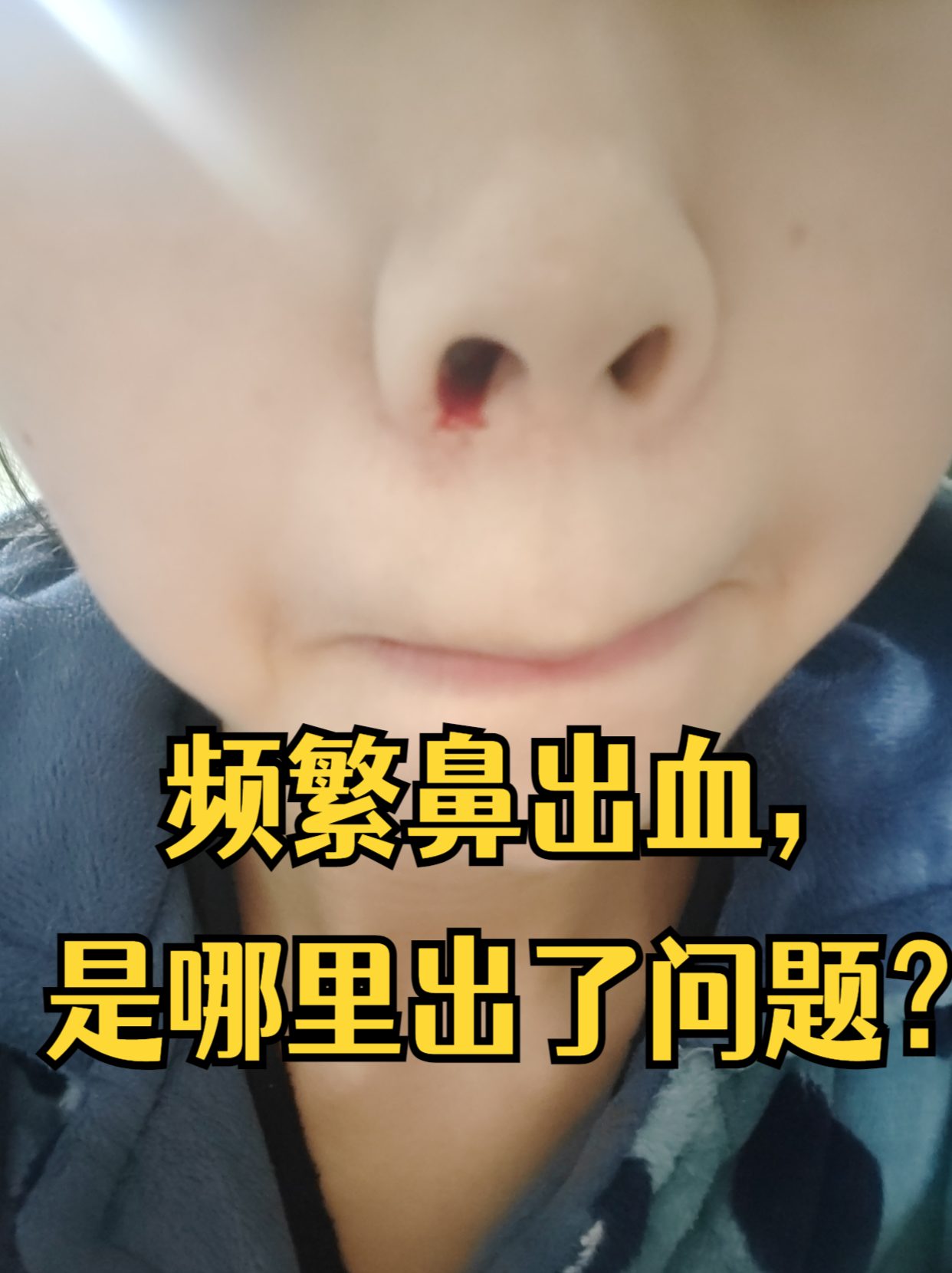 鼻出血频繁多与局部或全身因素相关,并非都由 "上火" 引起,需明确