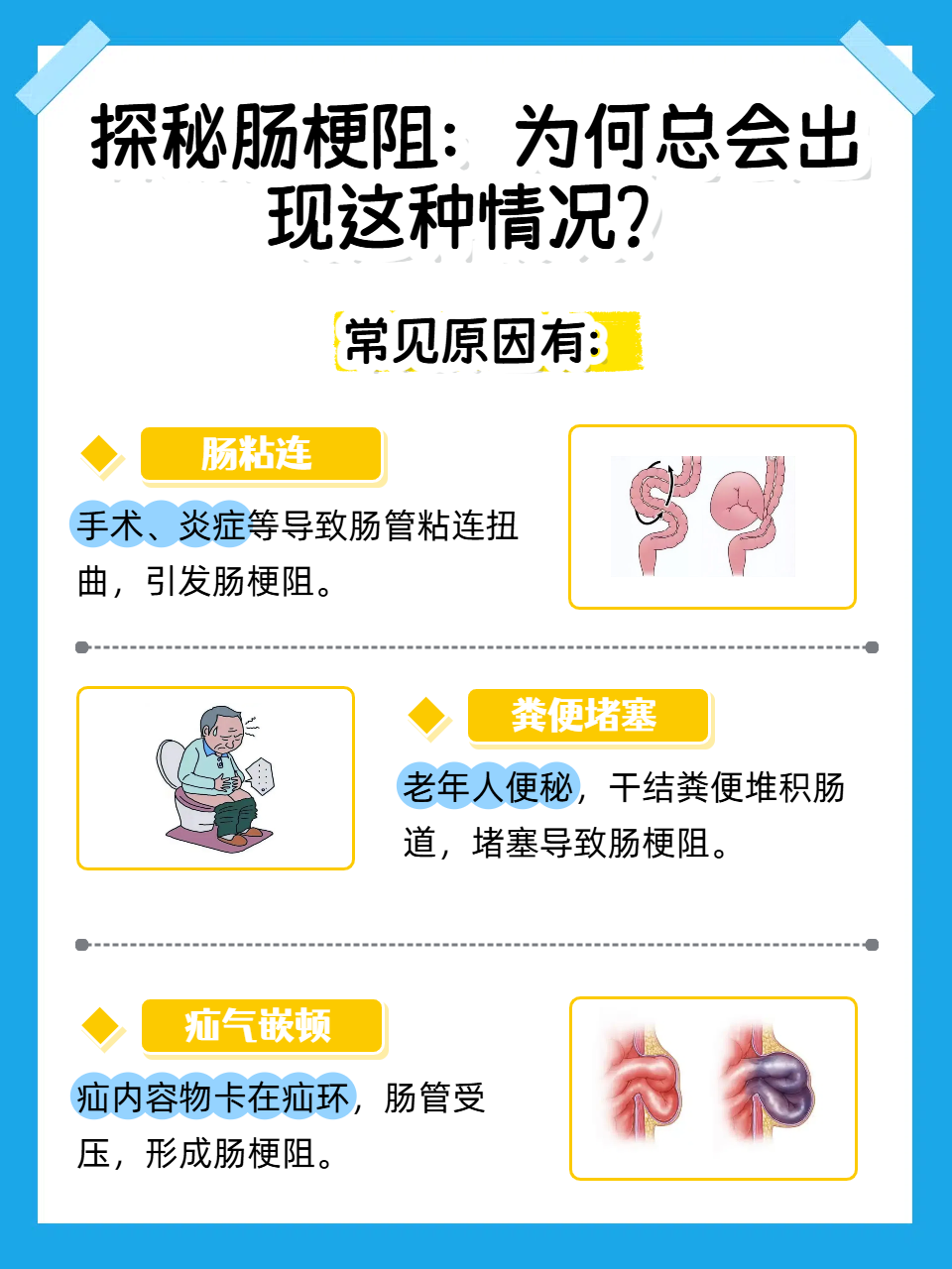 为什么会得肠梗阻的原因为什么在线 为什么会得肠梗阻的原因为什么在线