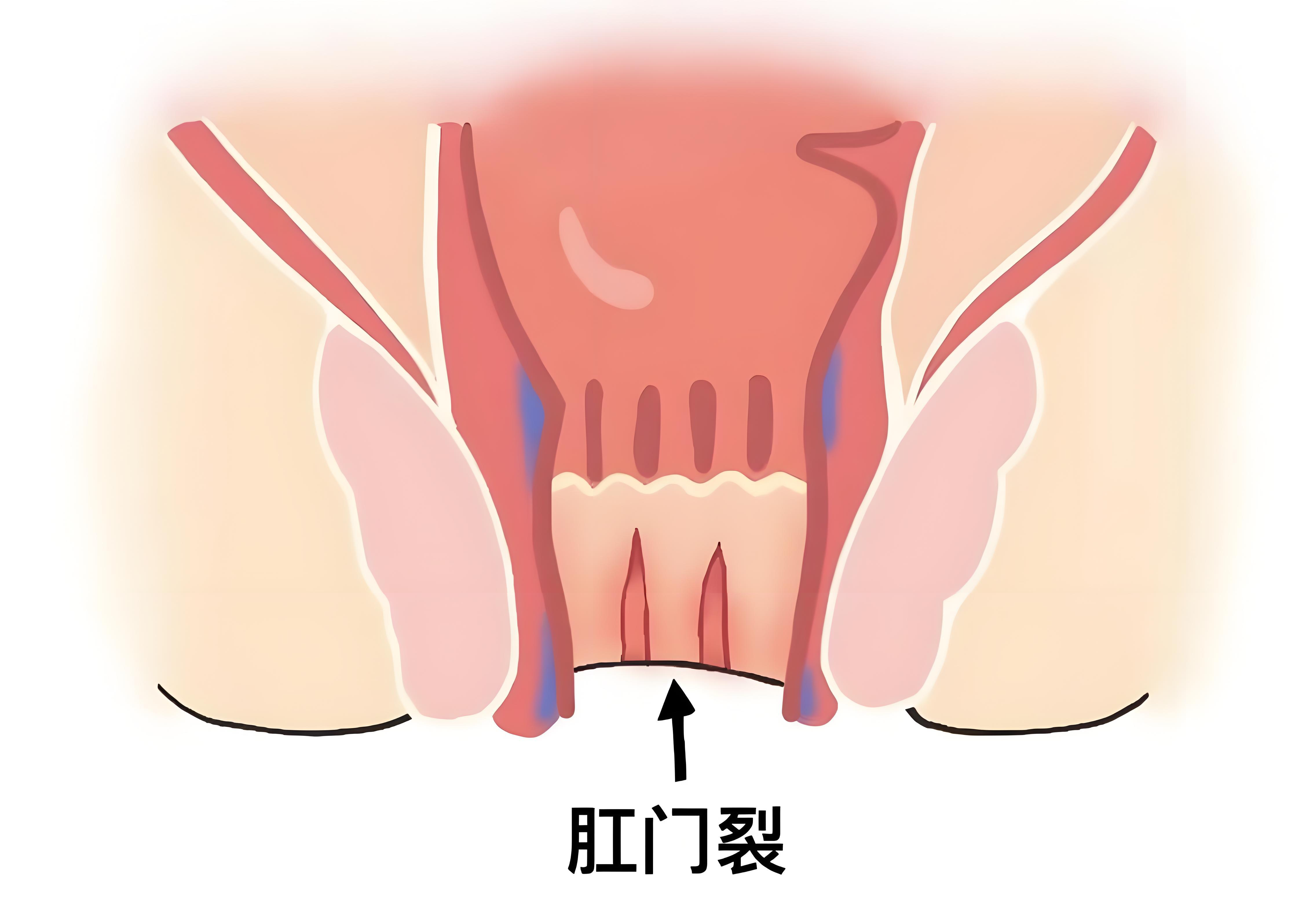 究竟是什么导致了肛裂疼痛?这些原因一定要清楚,才能对症缓解!