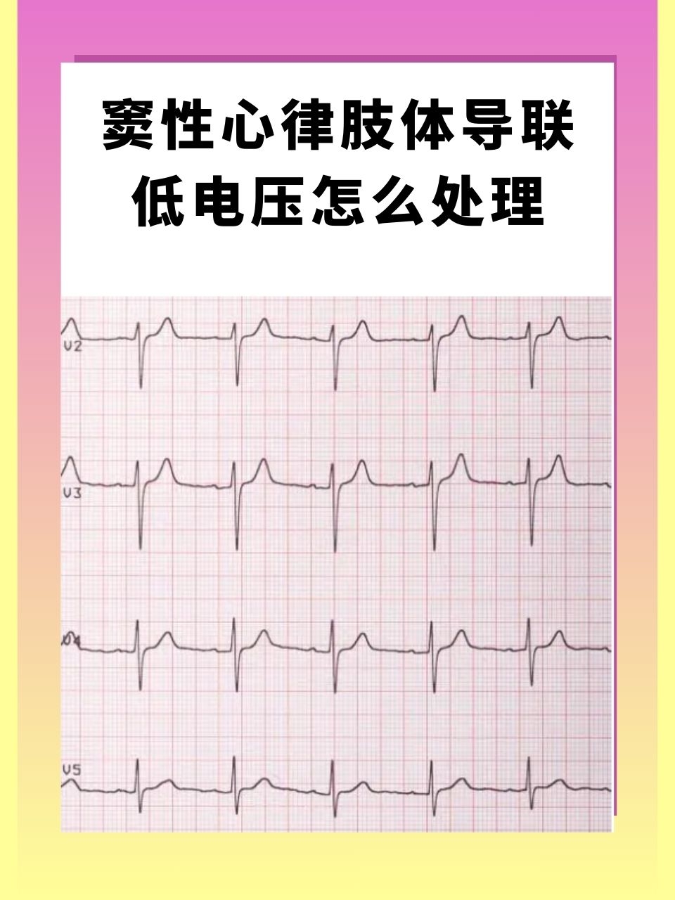 那么,当我们遇到窦性心律肢体导联低电压时,应该如何处理呢?