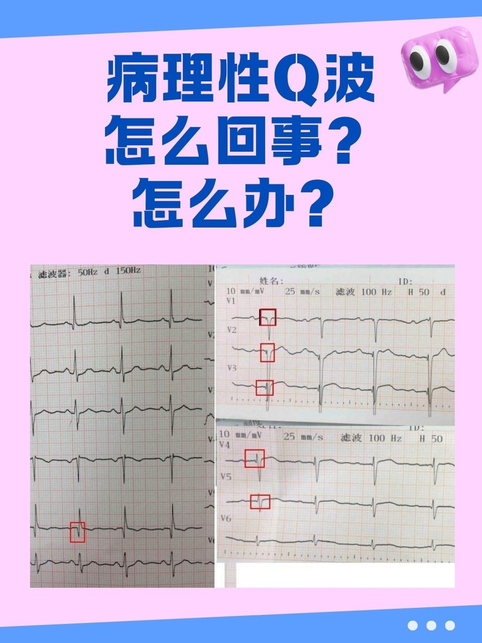 病理性q波的图片图片