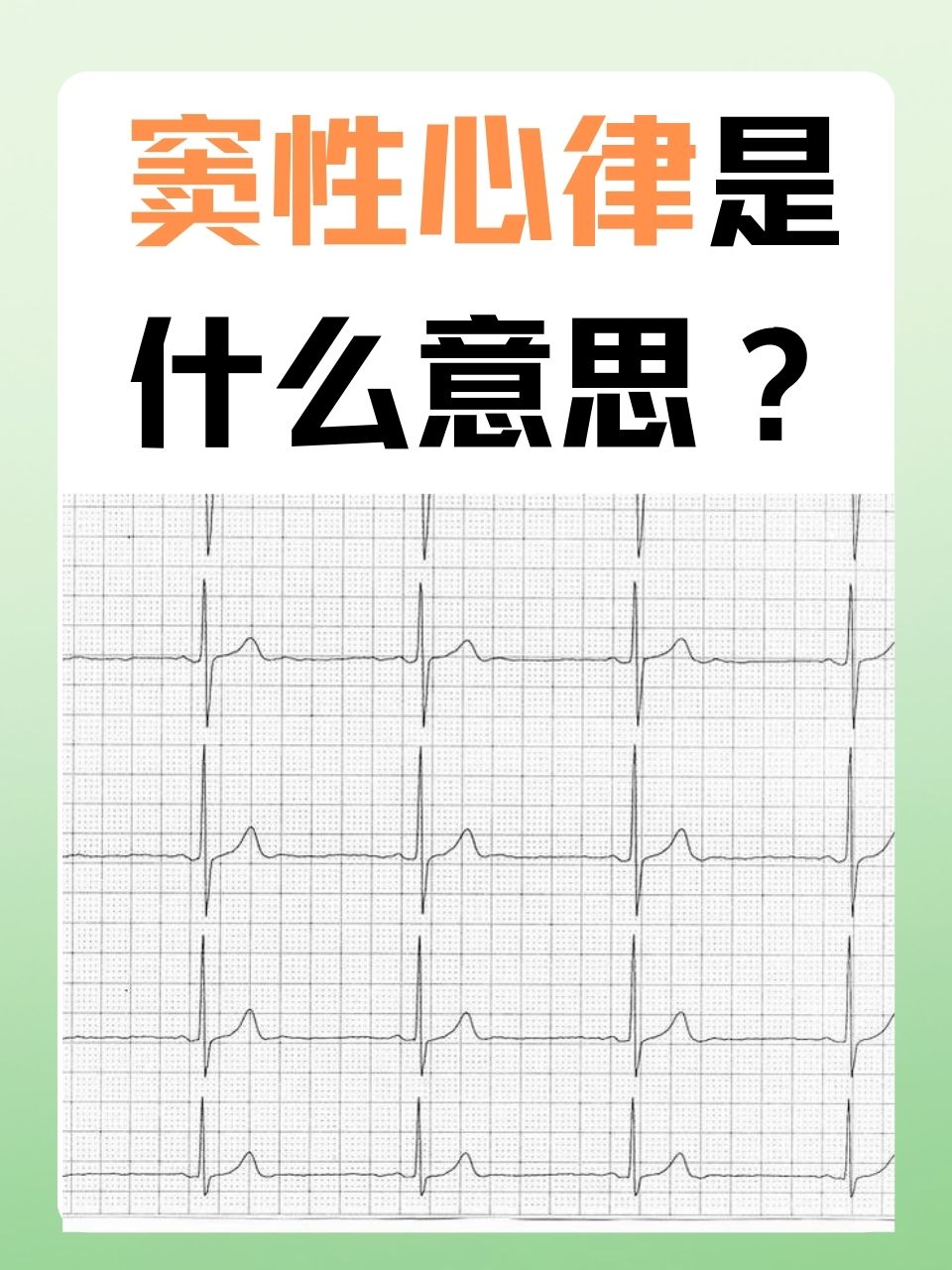 窦性心律不齐图解图片