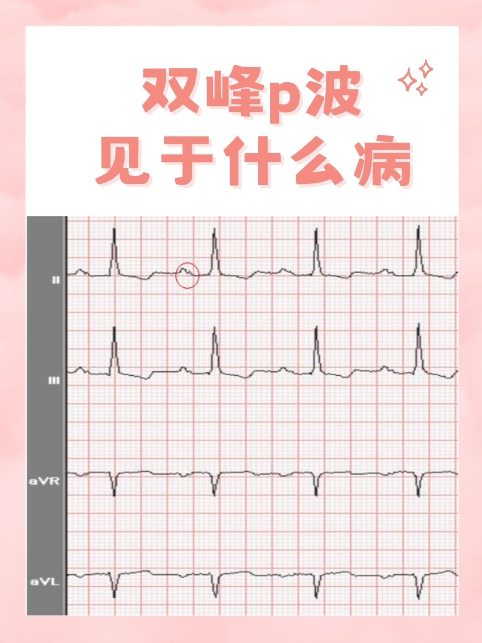 心电图T波双向图片