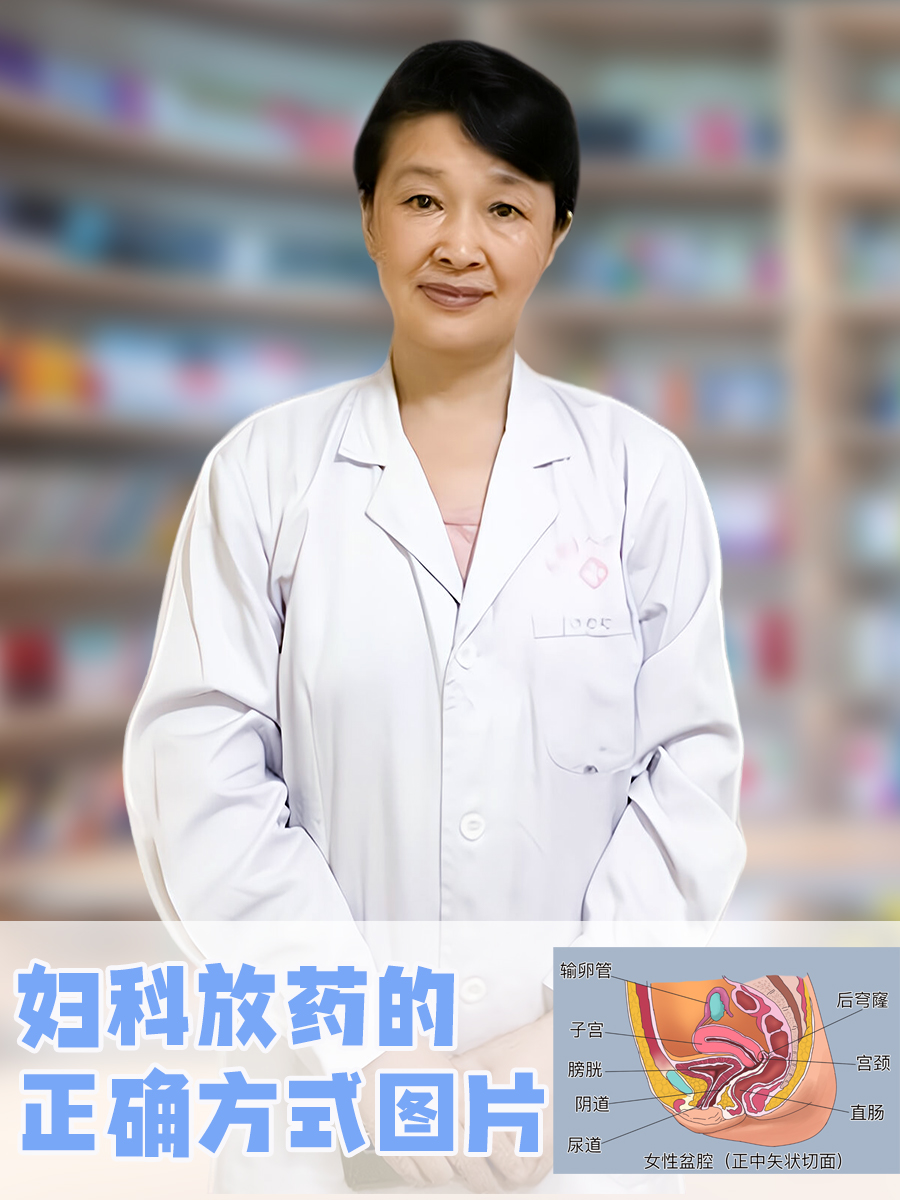 妇科放药的正确方式图片