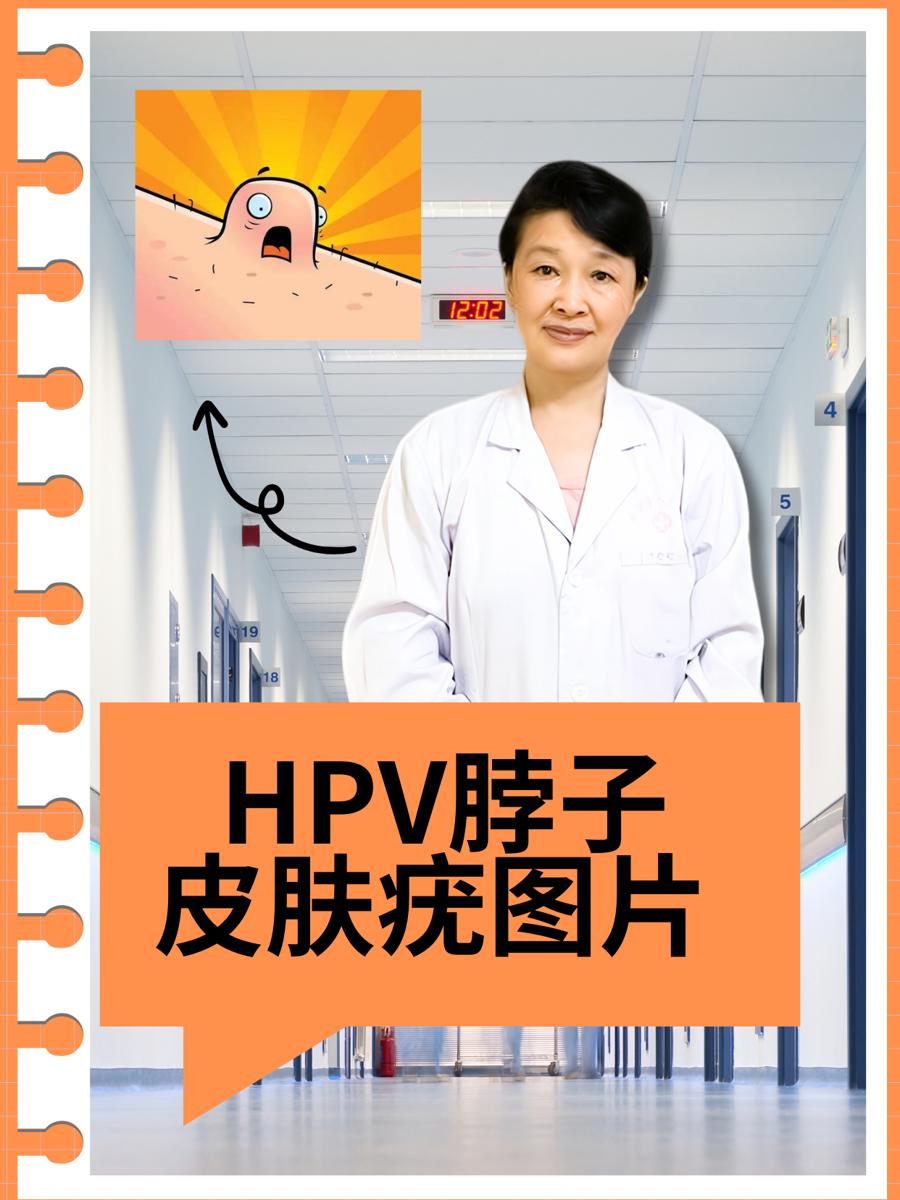 hpv脖子皮肤疣图片  在日常生活中