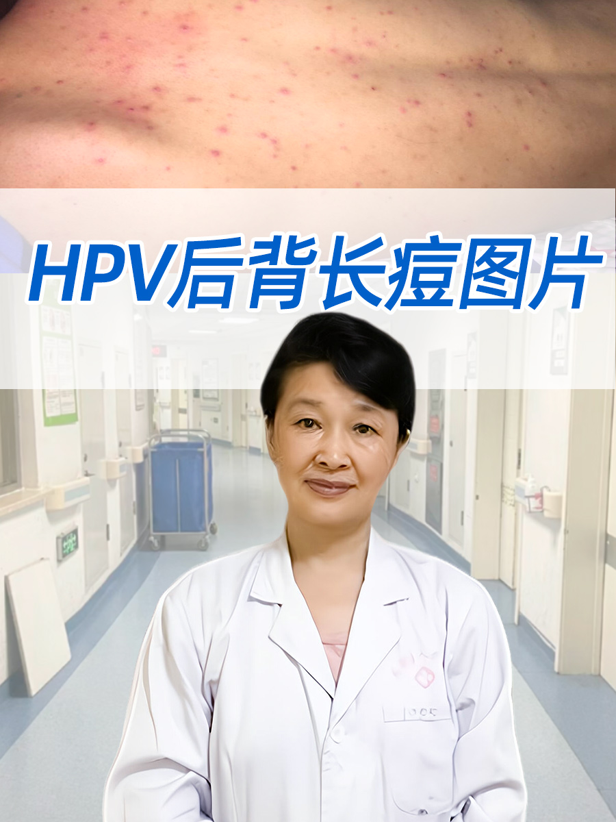 虽然hpv主要以其与宫颈癌等性传播疾病的关系而闻名,但它也能以不同