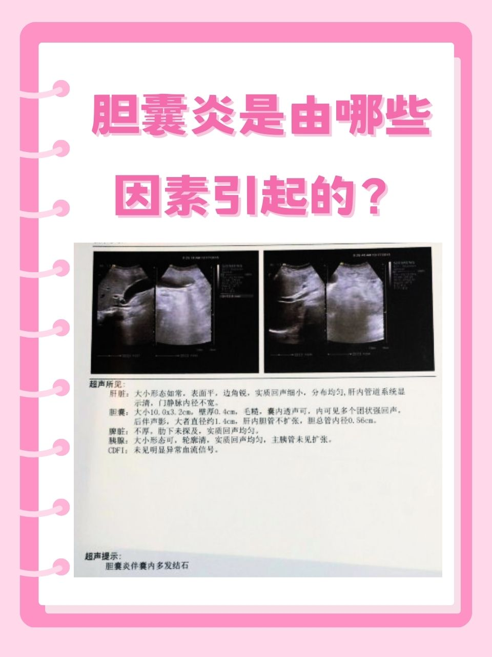 胆囊炎,是一个常见的肝胆问题.简单来说,就是胆囊的黏膜发炎了.