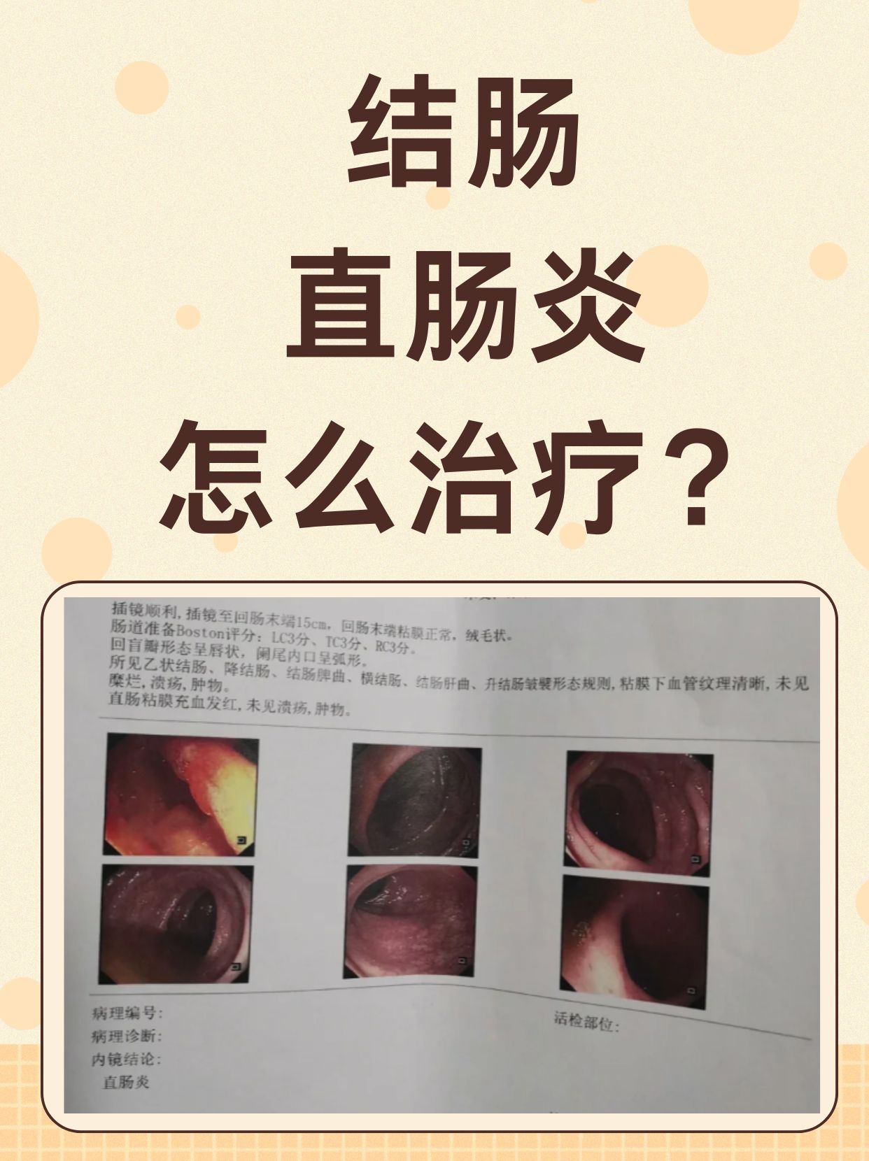 结肠直肠炎是一种常见的肠道疾病,给患者带来