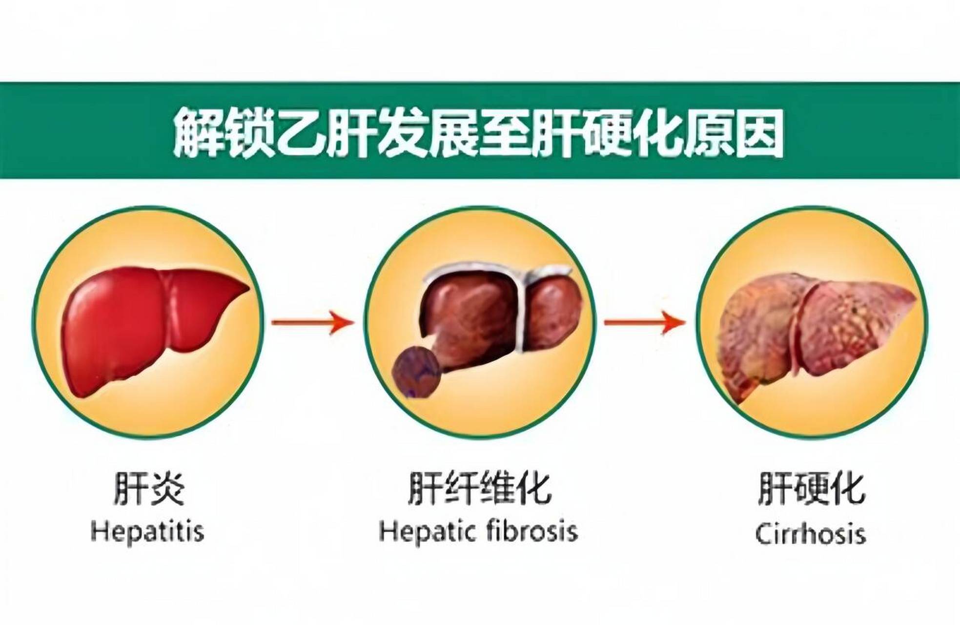 有没有肝纤维化,做这几项检查就清楚!