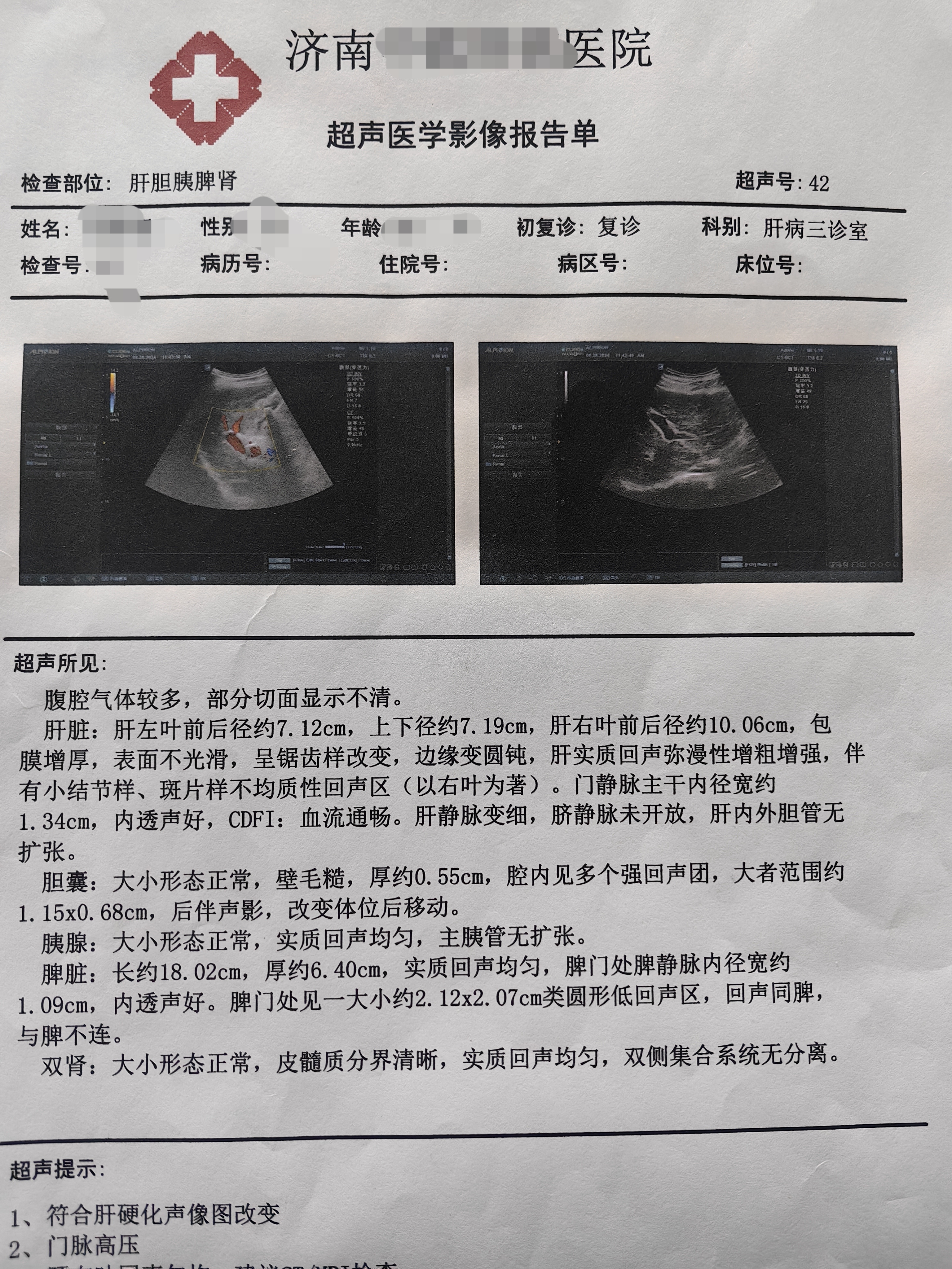 判断肝硬化恶性程度,还需综合多方面因素