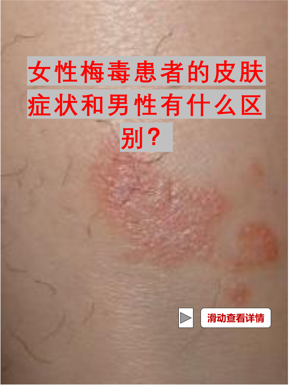 女性梅毒患者的皮肤症状和男性有什么区别?