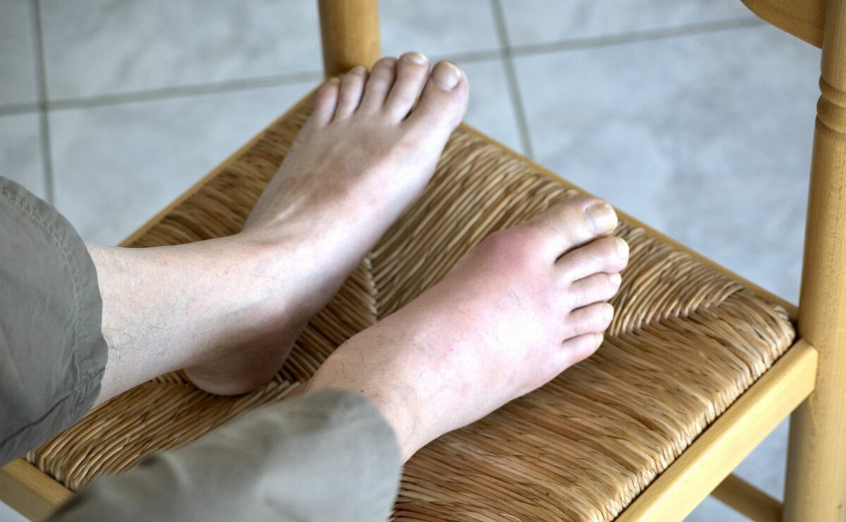 痛风石形成,吃药能溶解吗