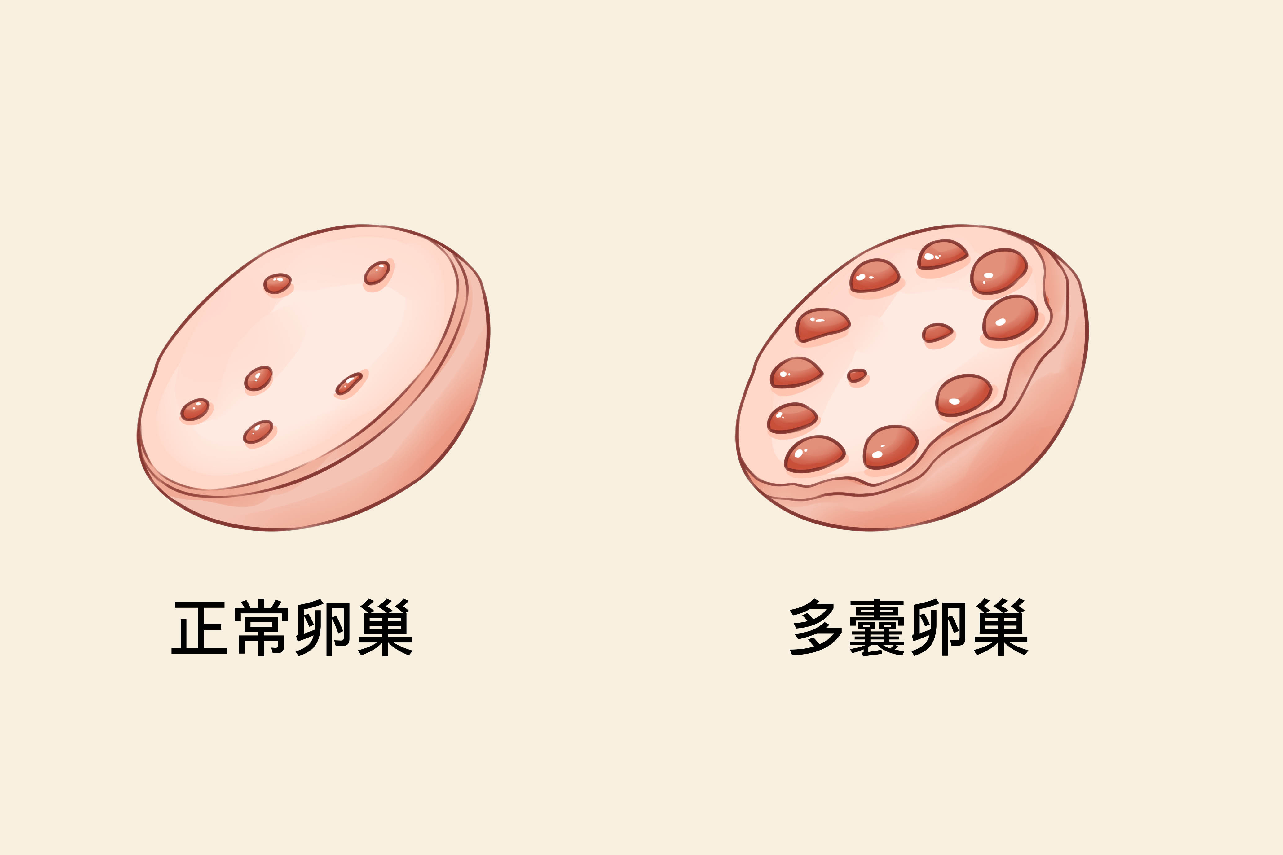 多囊性卵巢影响生育吗(多囊卵巢影响性生活质量嘛)