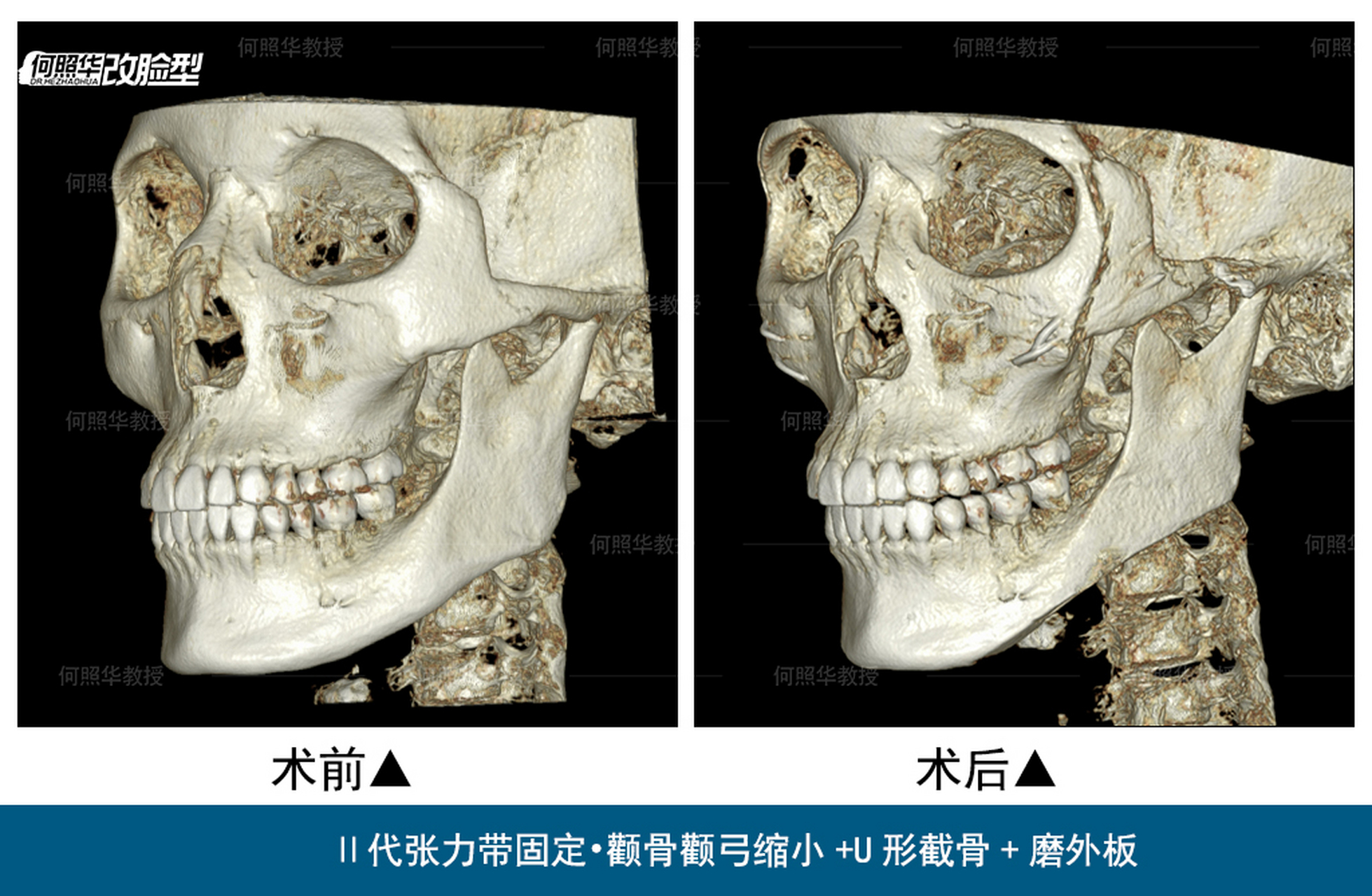 颧骨颧弓下颌角图片