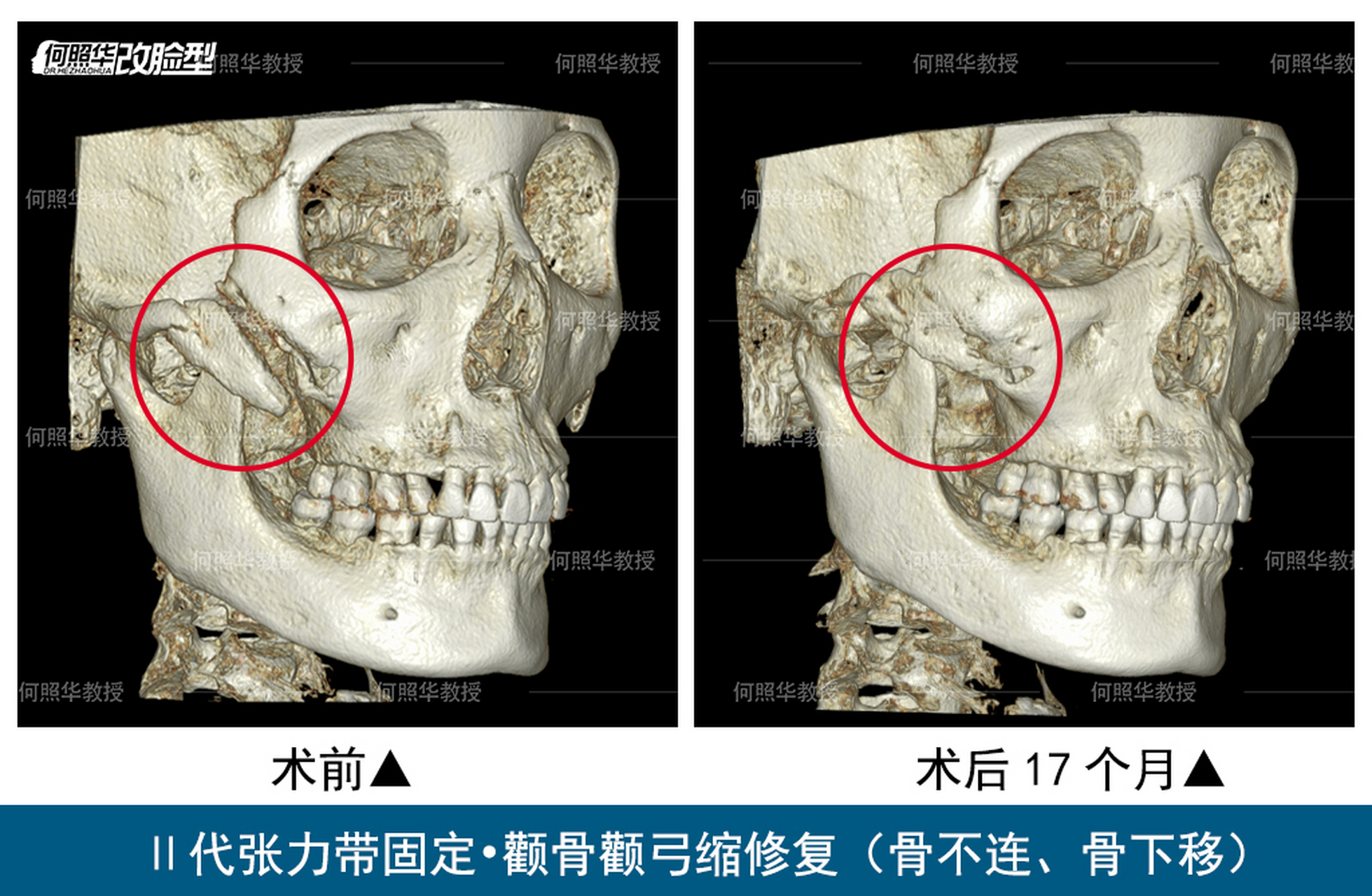 颧骨颧弓整形术图片