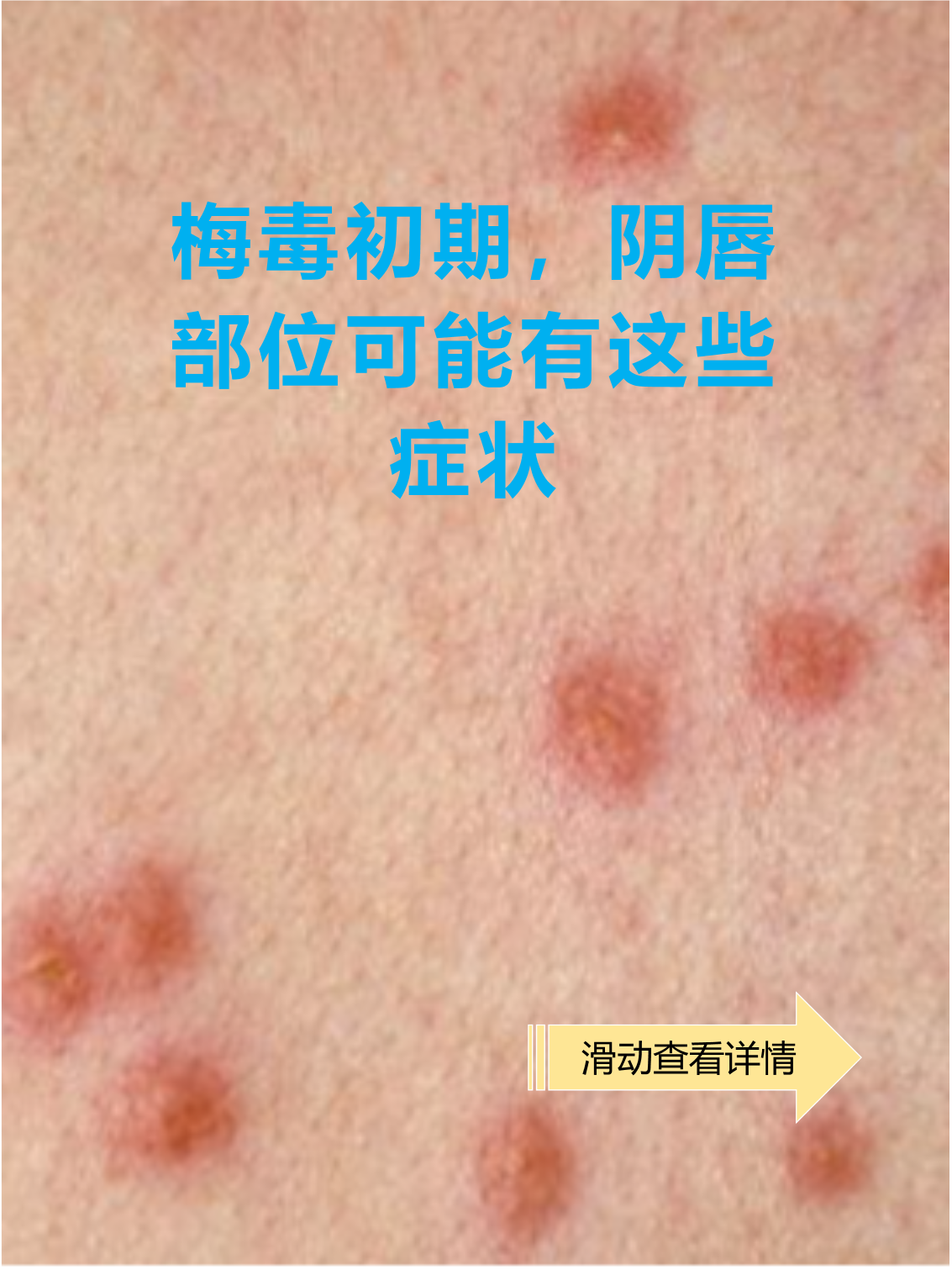 常见症状表现 硬下疳:感染后2