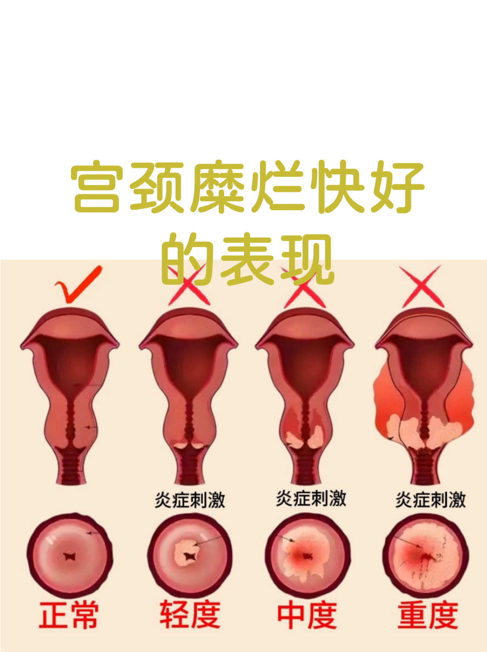 宫颈糜烂恢复表现 分泌物减少:白带量逐渐恢复正常,颜色从黄色