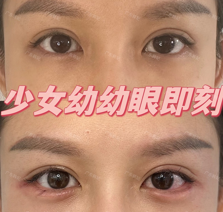 新月型双眼皮是眼头和眼尾的地方比较窄,但是眼睛的中间部分是比较宽