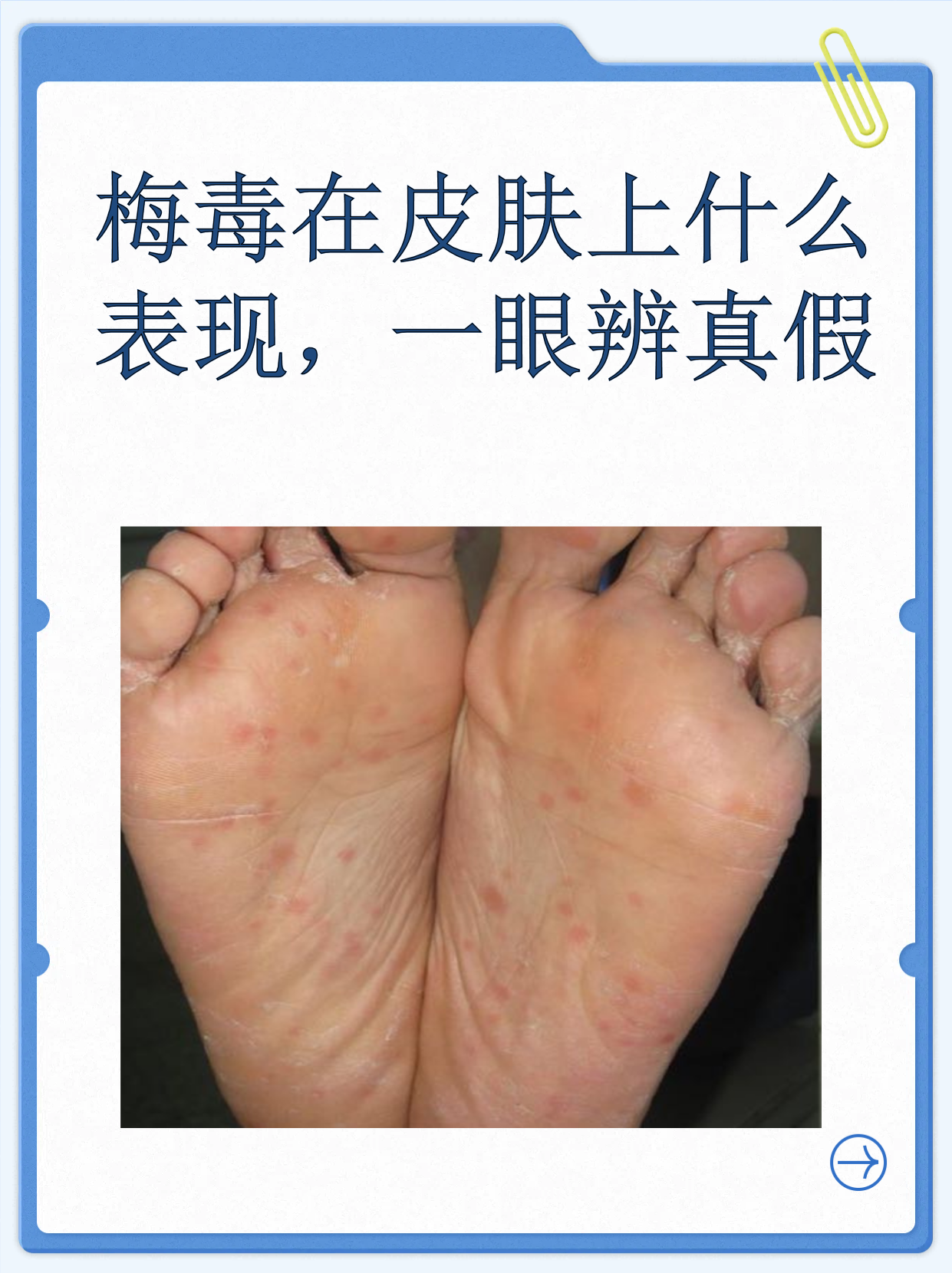 梅毒在皮肤上什么表现,一眼辨真假