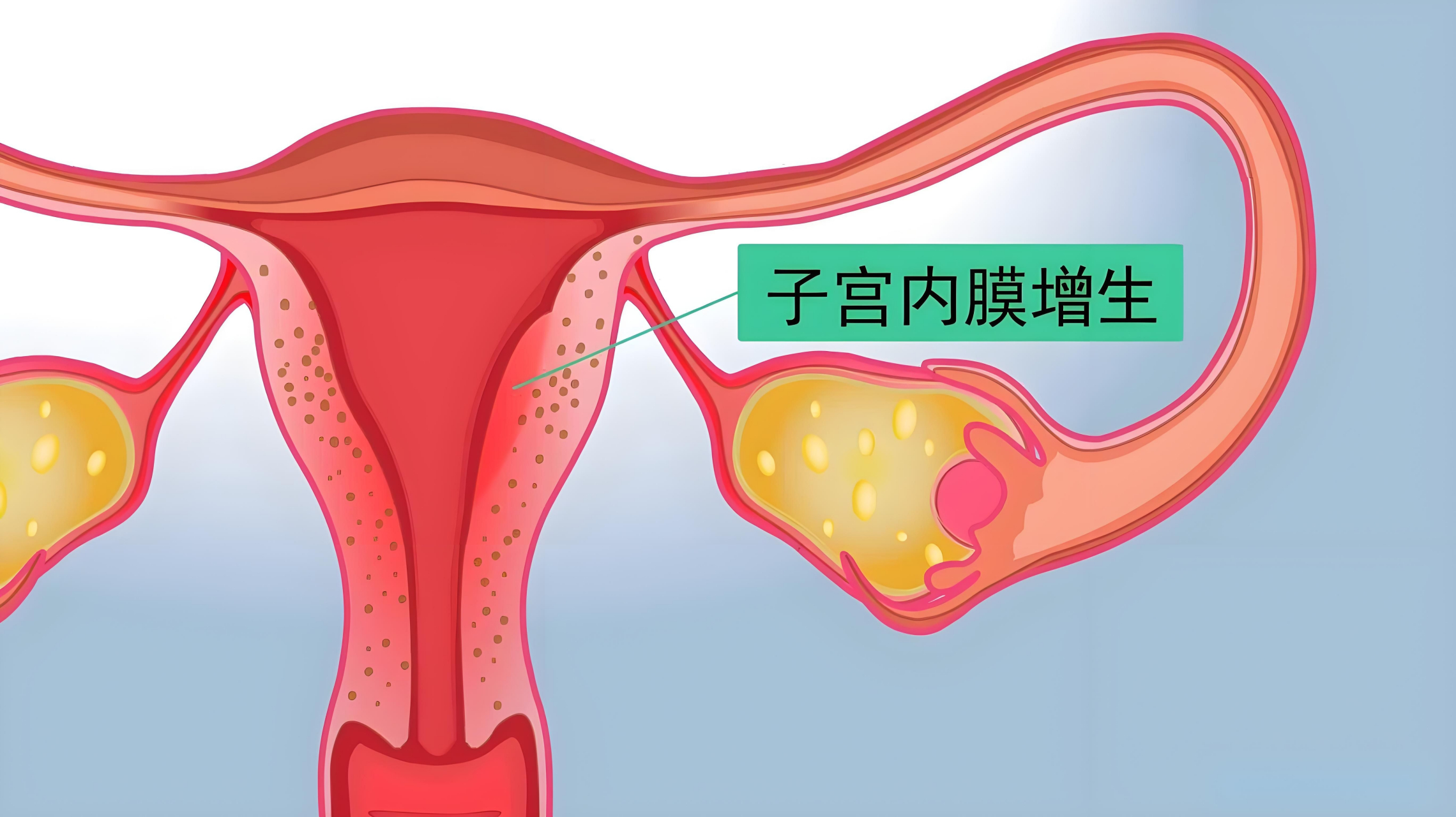 子宫内膜什么样子图片图片