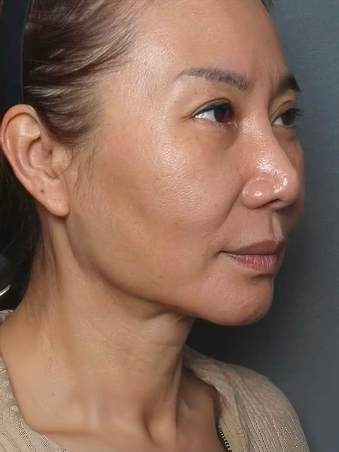 70后,脸蛋松垮没精神,在北京都花了4w做"无痕筋膜